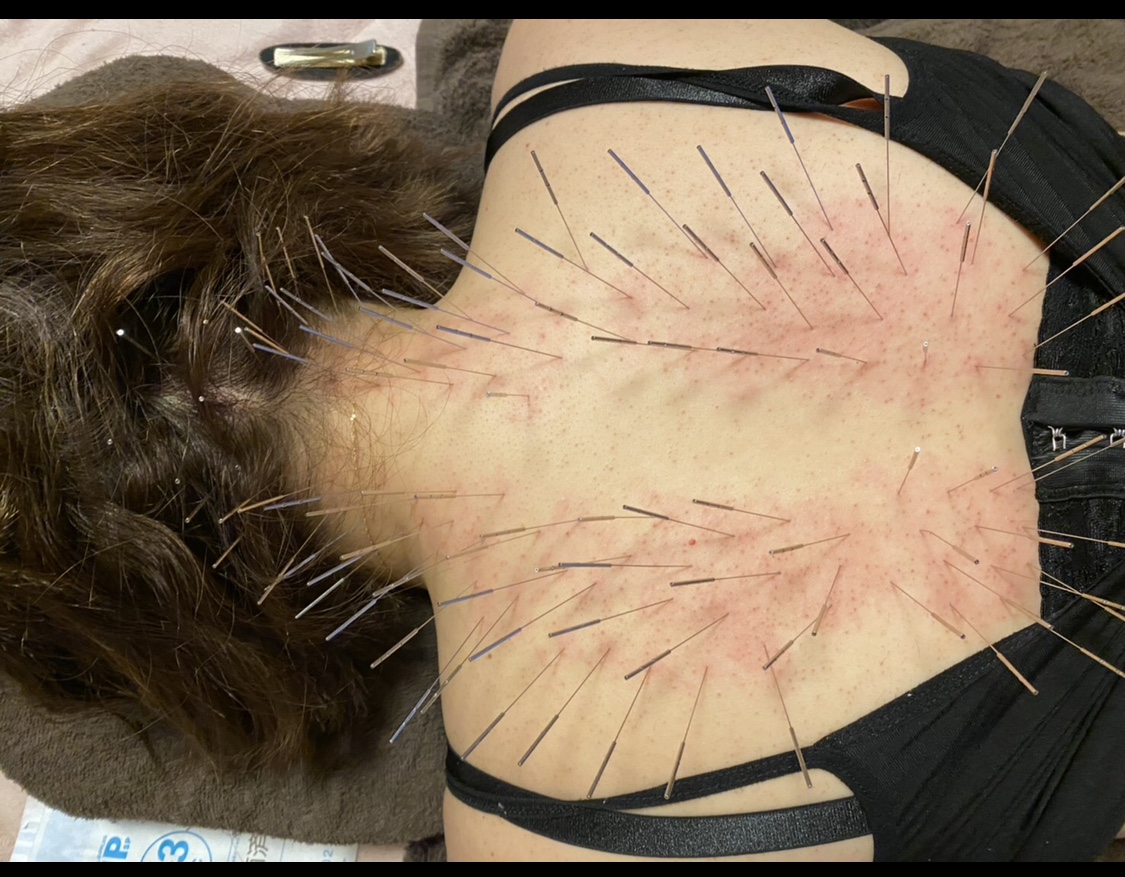 Iris鍼灸整体 60分ルート治療のメニュー画像