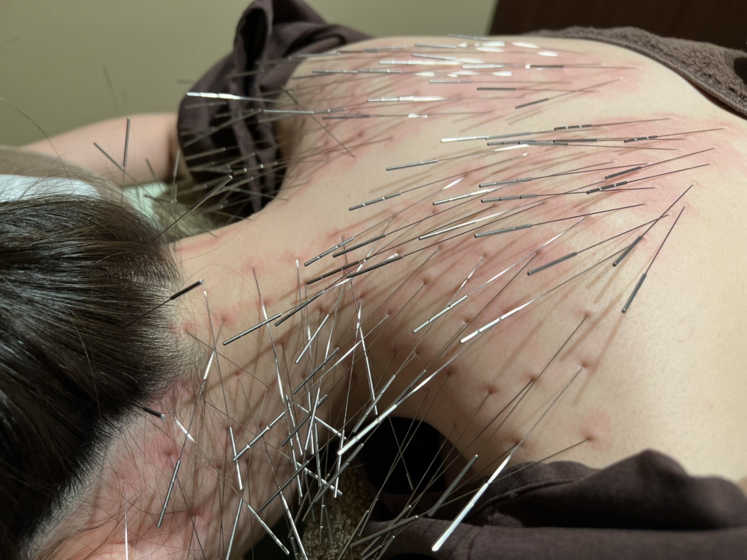 ORIENT THERAPY　ルート治療・鬼神美容鍼（ルート治療ベース）・電気美容鍼・刺さない極美鍼・難聴特化型鍼サロン ルート治療（スタンダード）のメニュー画像