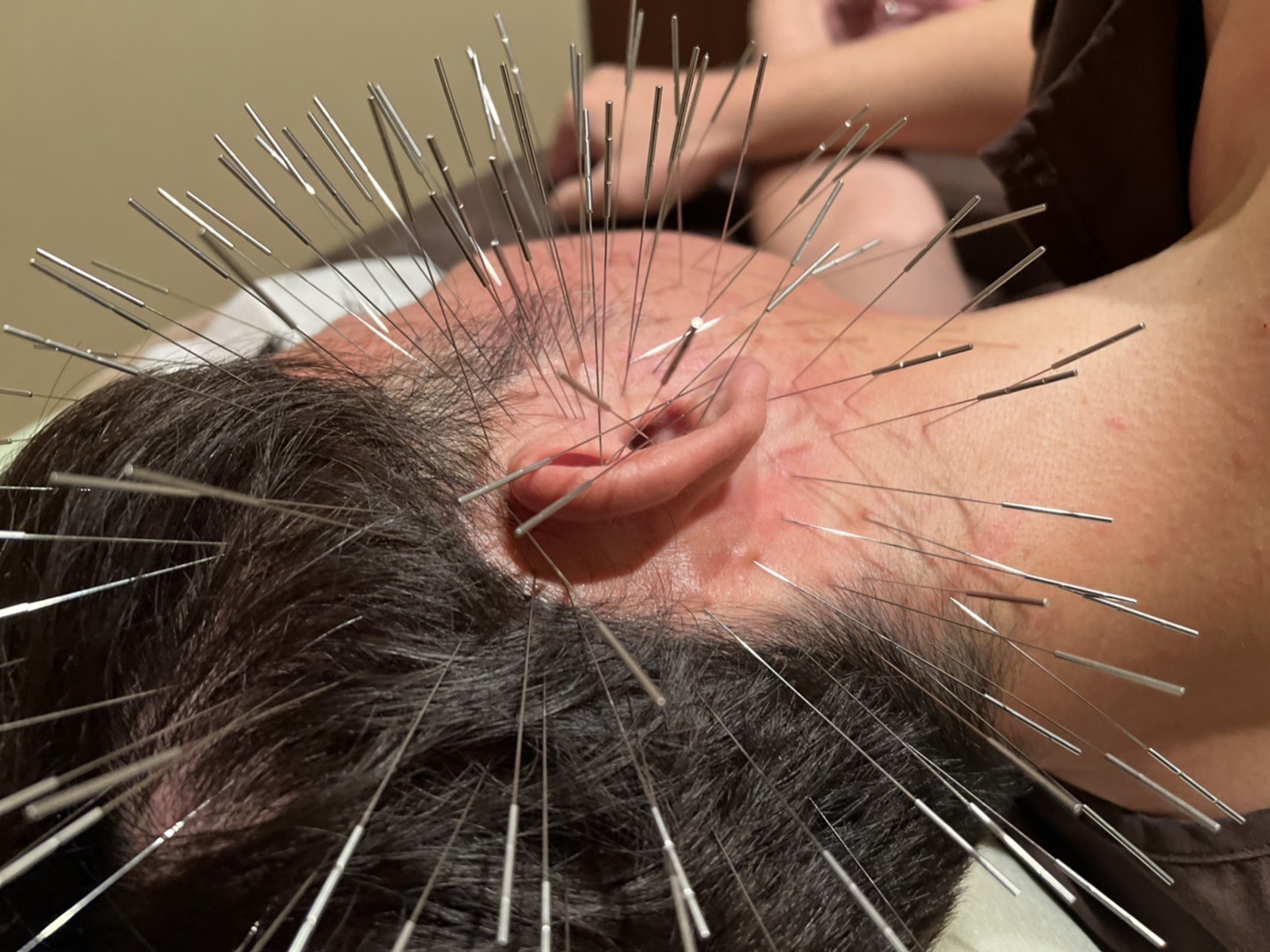 ORIENT THERAPY　ルート治療・鬼神美容鍼（ルート治療ベース）・電気美容鍼・刺さない極美鍼・難聴特化型鍼サロン 難聴特化型施術のメニュー画像