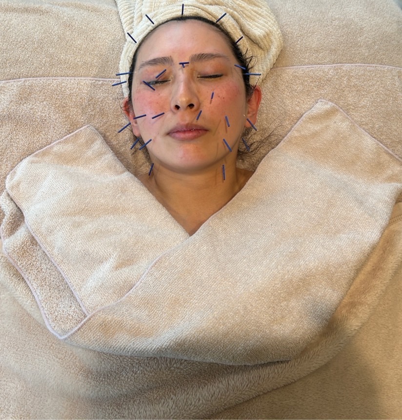 鍼灸サロン mana 2回目以降【小顔/美顔】 美容鍼×ヒト幹細胞美容液導入×体質改善全身鍼のメニュー画像