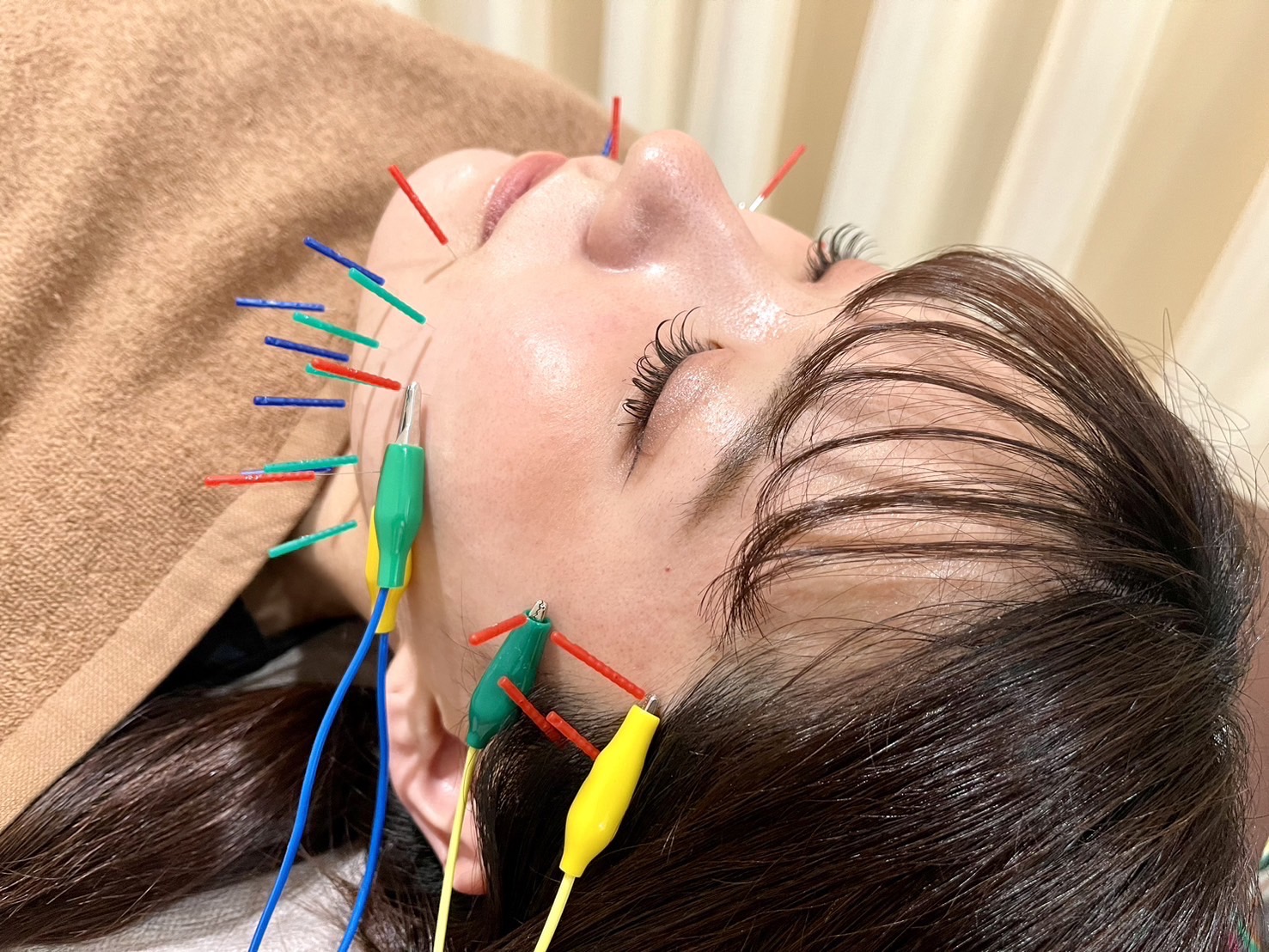 ことほぎ鍼灸整体 奈良登美ヶ丘院 美容鍼のメニュー画像