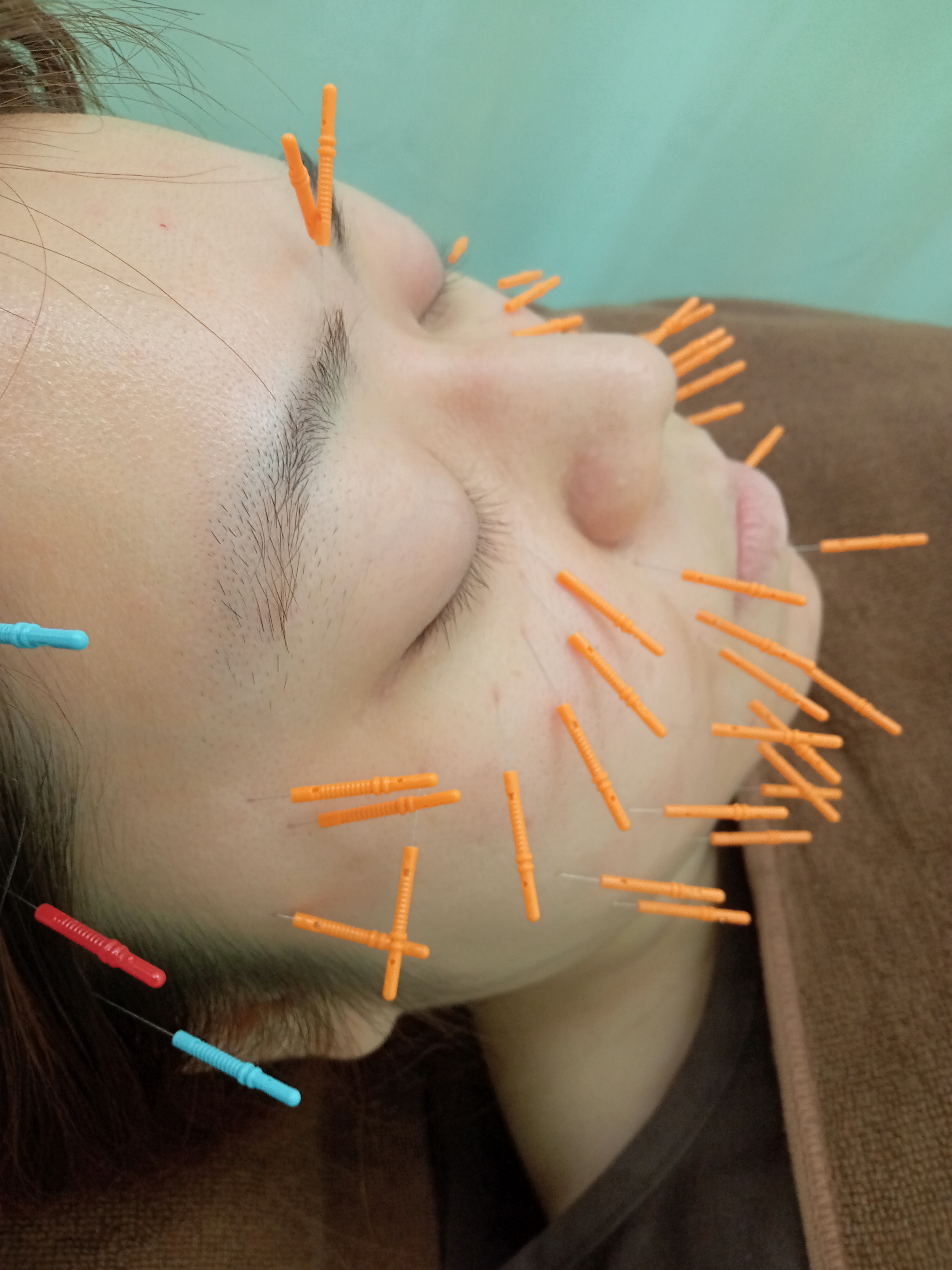 諏訪の杜鍼灸院 美容鍼灸コースのメニュー画像