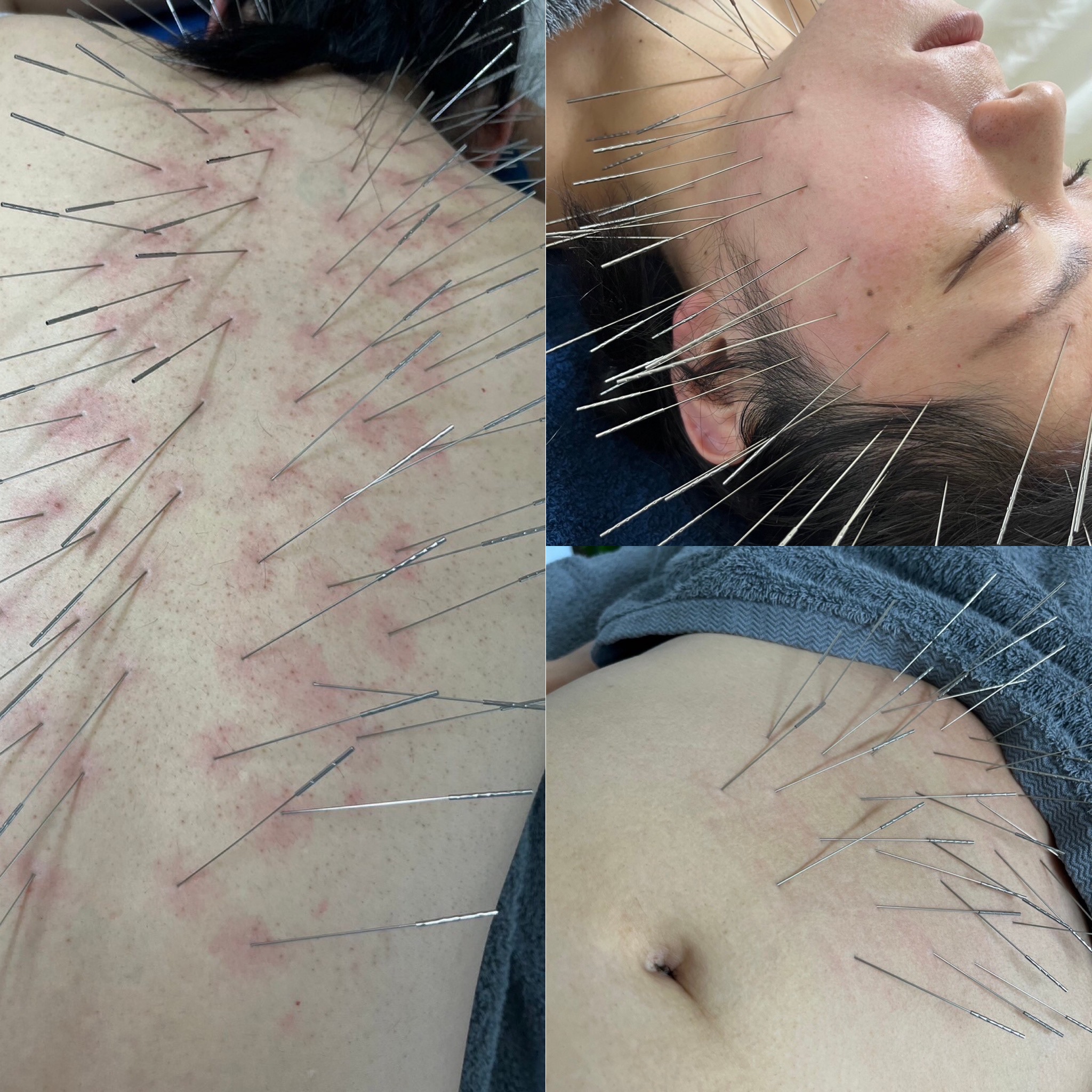 Iris鍼灸整体 鬼美容鍼➕全身ルート治療のメニュー画像