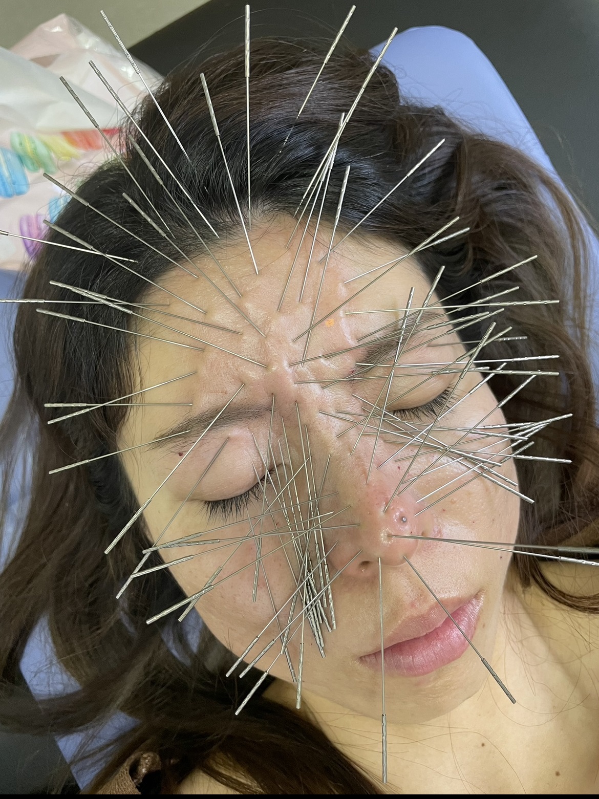 鍼処SHIRAKAWA 浦和院 ルート鬼美容鍼のメニュー画像