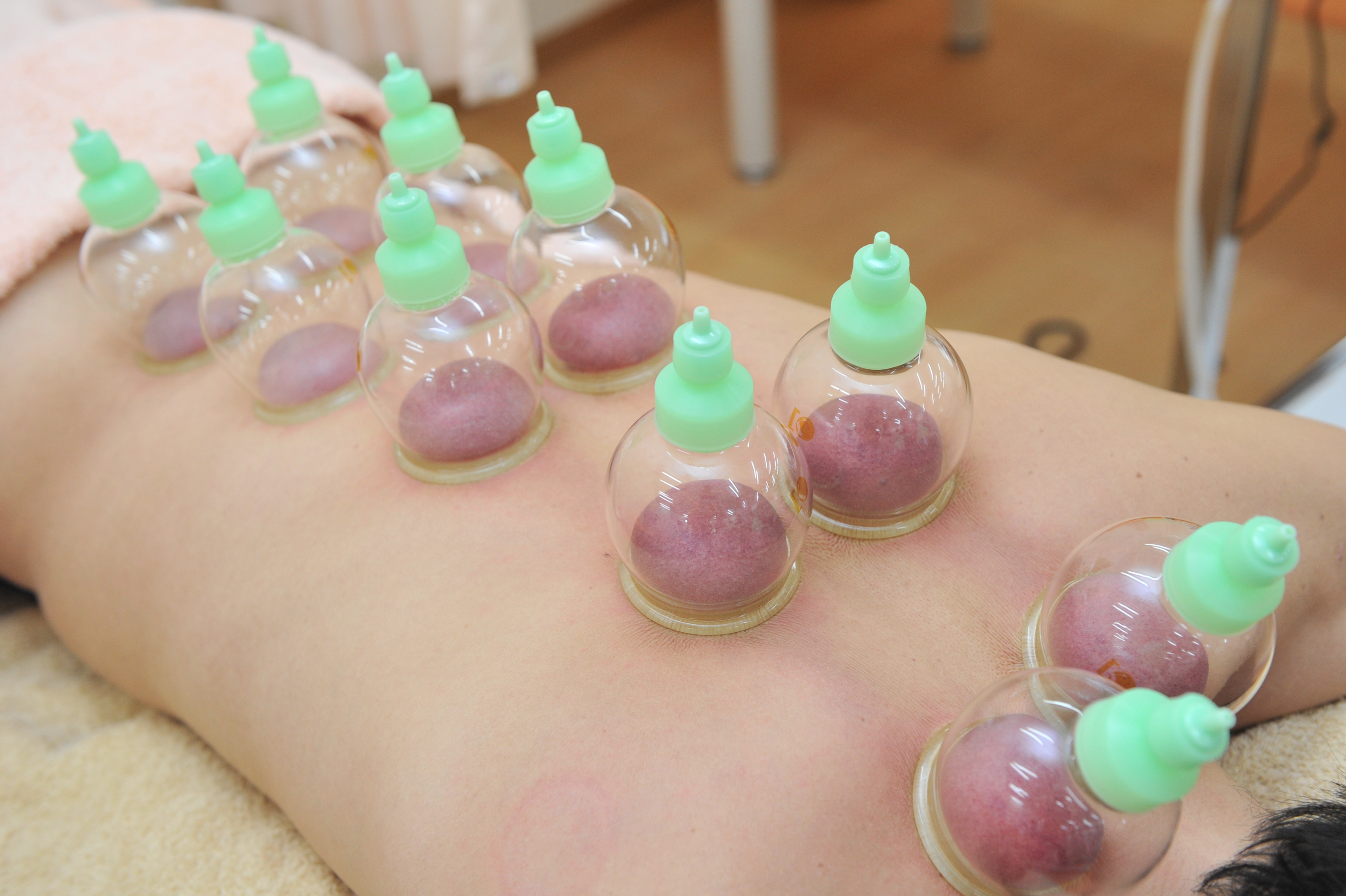 みずの坂鍼灸マッサージ整骨院 整体院 吸い玉(カッピング)のメニュー画像