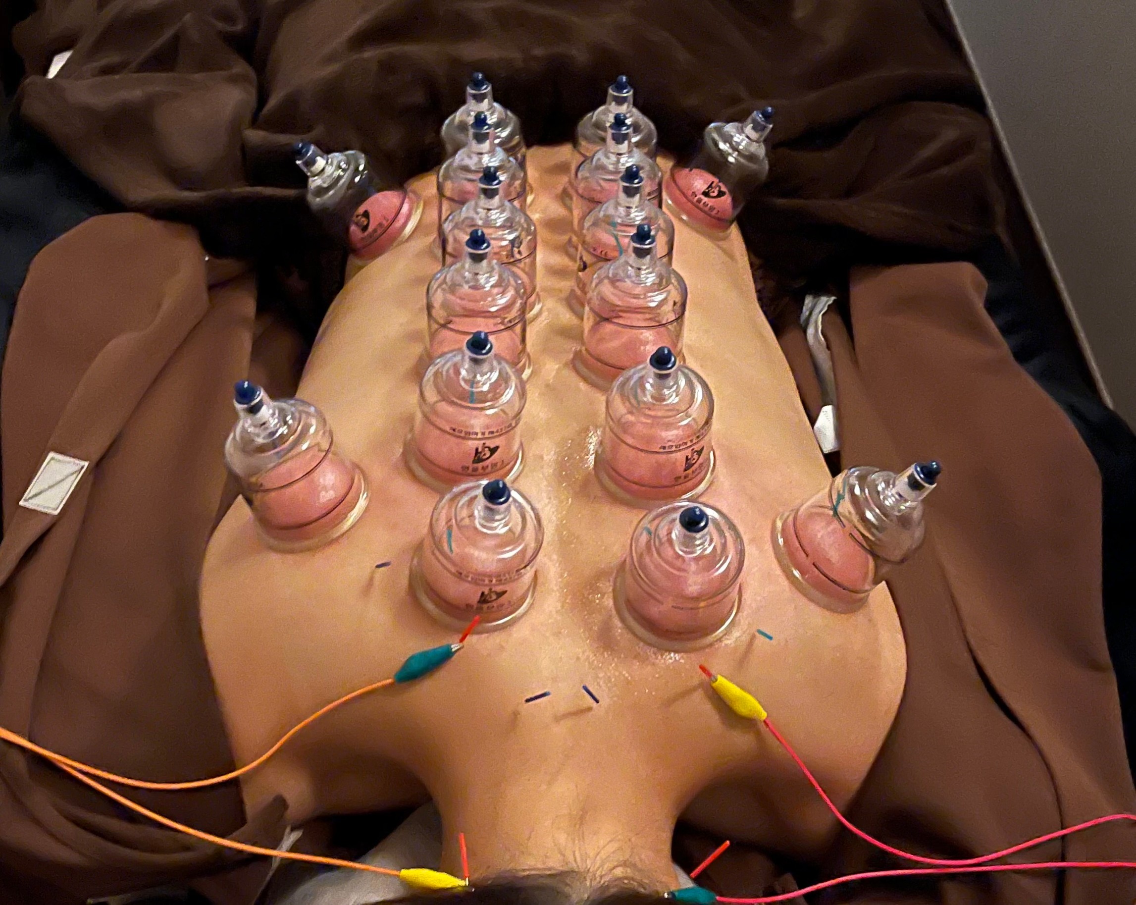 HARiET 【オプション】鍼Ｘカッピングのメニュー画像