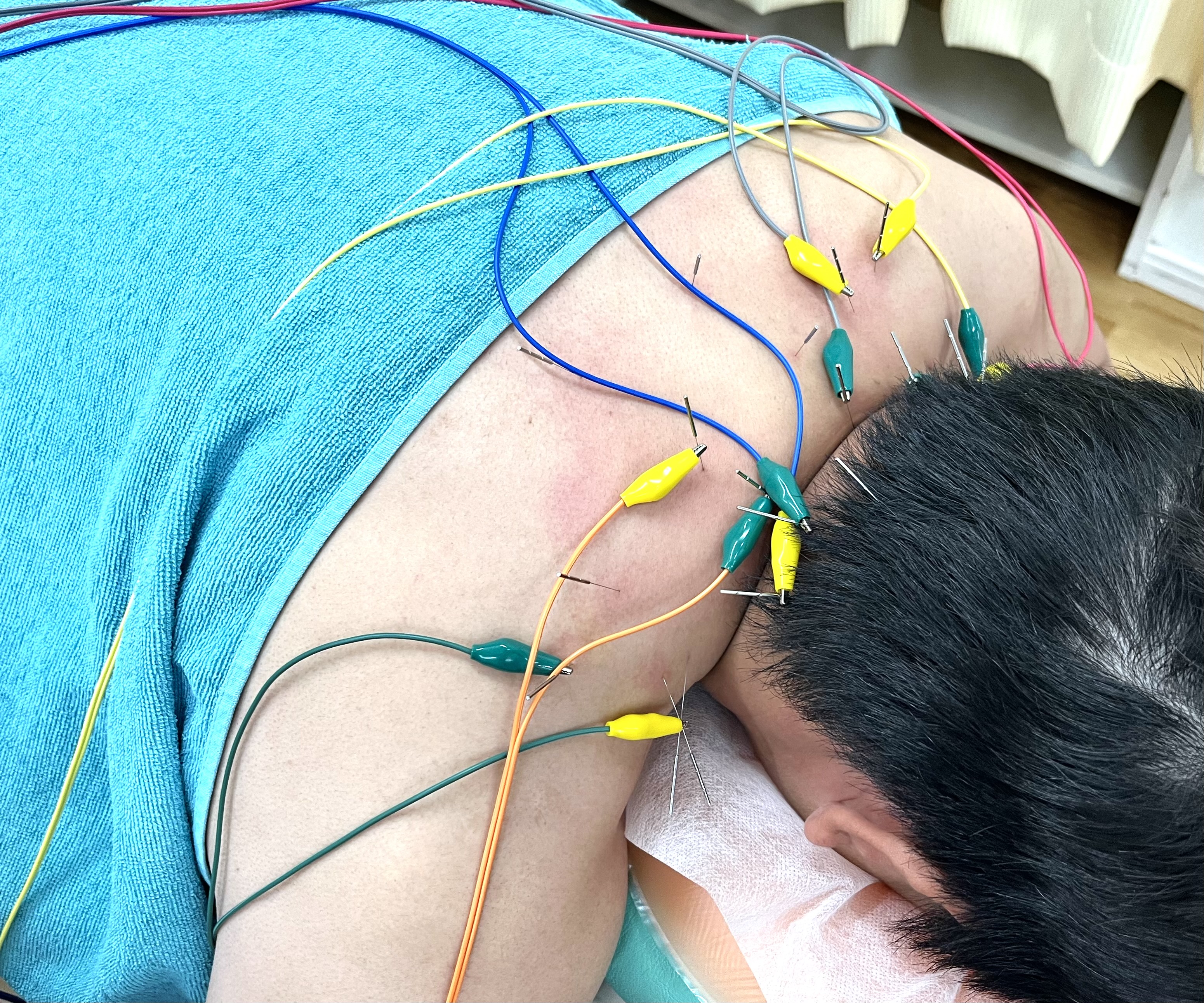 くじら鍼灸・整体院 ポイント鍼　慢性的な首こり肩こり、腰痛など1症状7700円～のメニュー画像