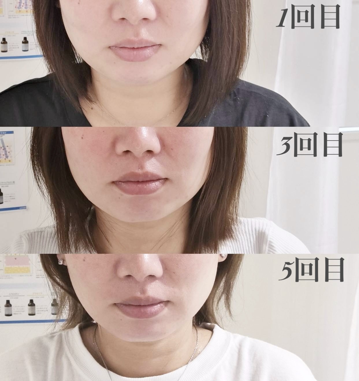 【メリハリ小顔・透明美肌】お顔の美容専門サロン-ハリステリア-≪H・S≫ 【針は恐いけどリフトアップしたい、、、そんなお客様専用】コラーゲン増し増しで肌ハリUPメニューのメニュー画像