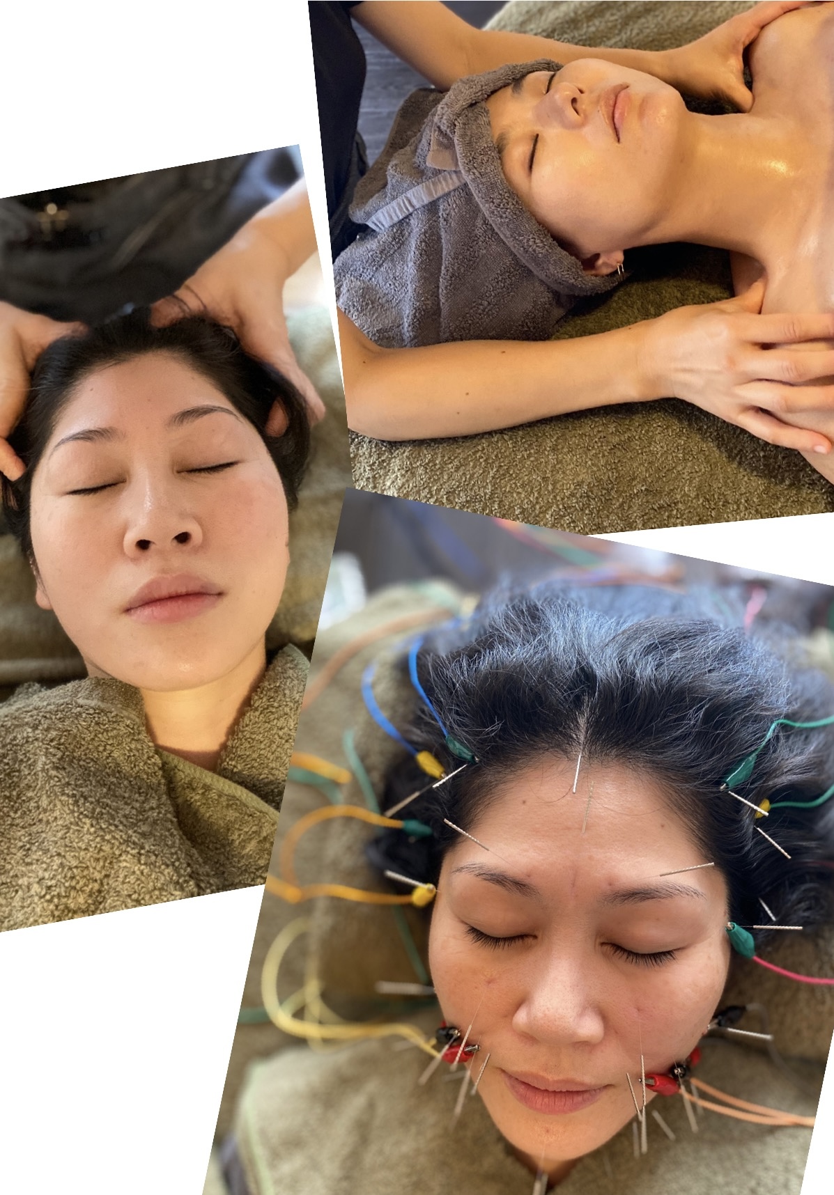 はり灸マッサージ統合治療院Hui (ホイ) 美容鍼灸60分¥8000  顔頭の電気鍼＋身体の鍼灸またはマッサージ調整のメニュー画像
