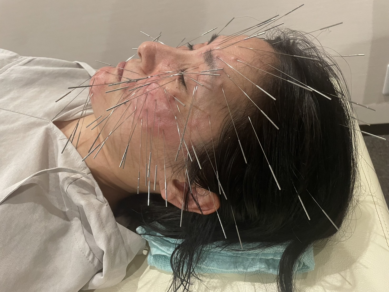 鍼灸整骨院拓【ルート治療院】 ルート鬼美容鍼のメニュー画像