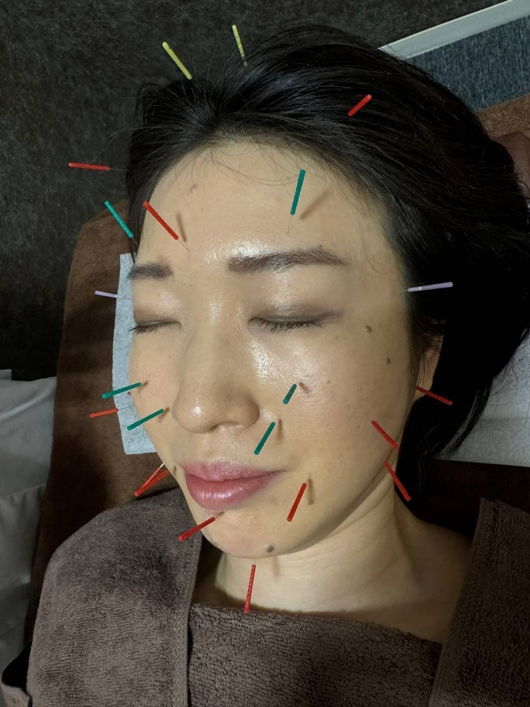 KAKA鍼灸院 美顔鍼のメニュー画像