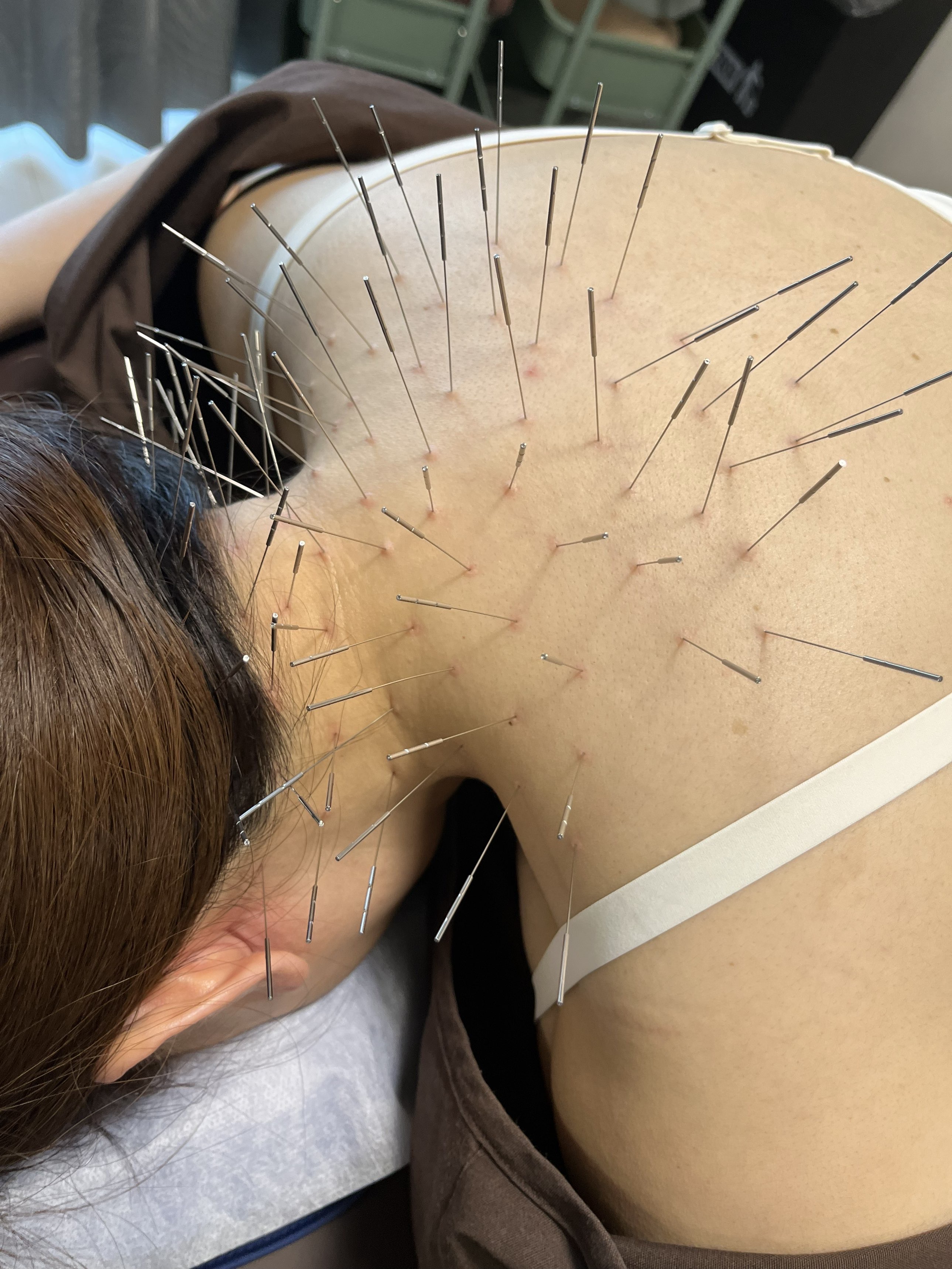 鍼処HIKARIE ルート治療【60分】【標準】（鬼美容鍼もできます）のメニュー画像