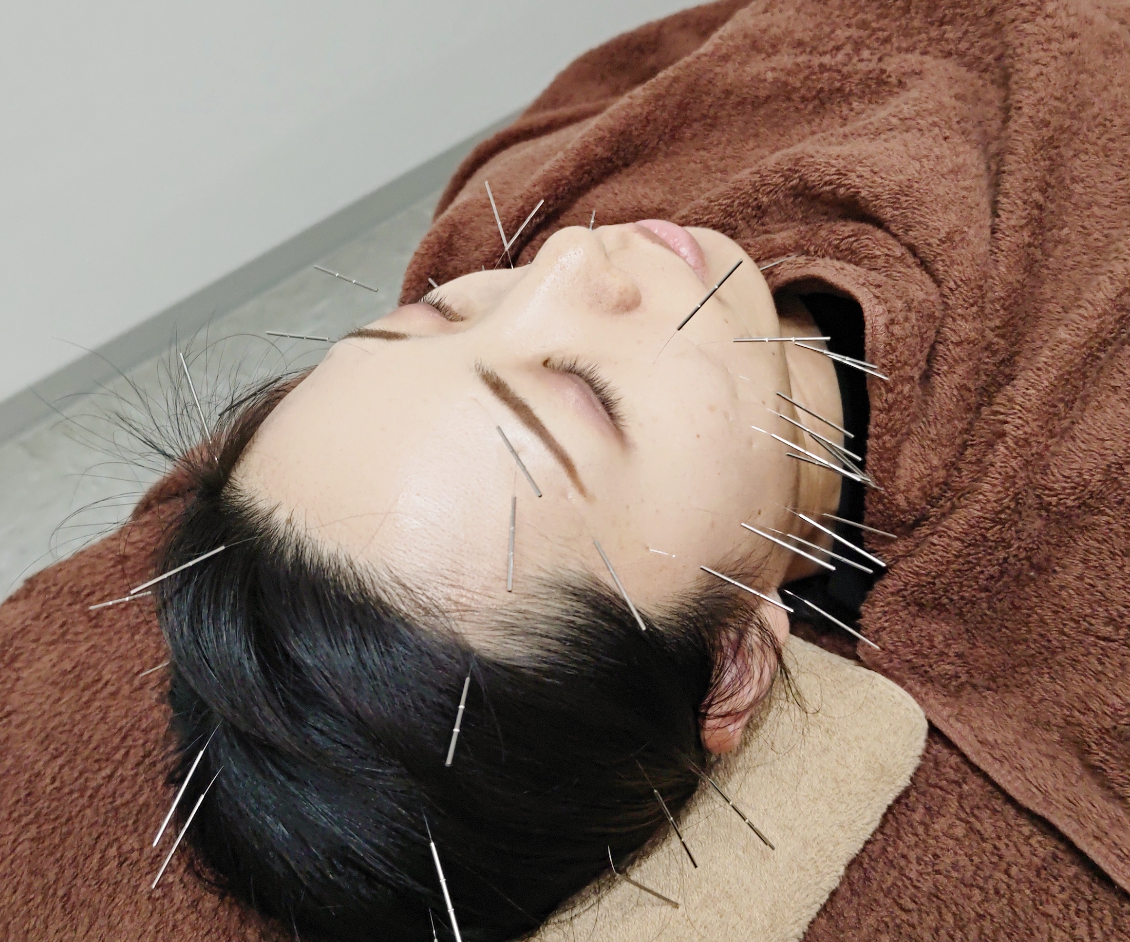 鍼灸整体院プラーナ 美容鍼灸プレミアムコース(全身鍼灸×体質改善×リフトアップ調整)のメニュー画像
