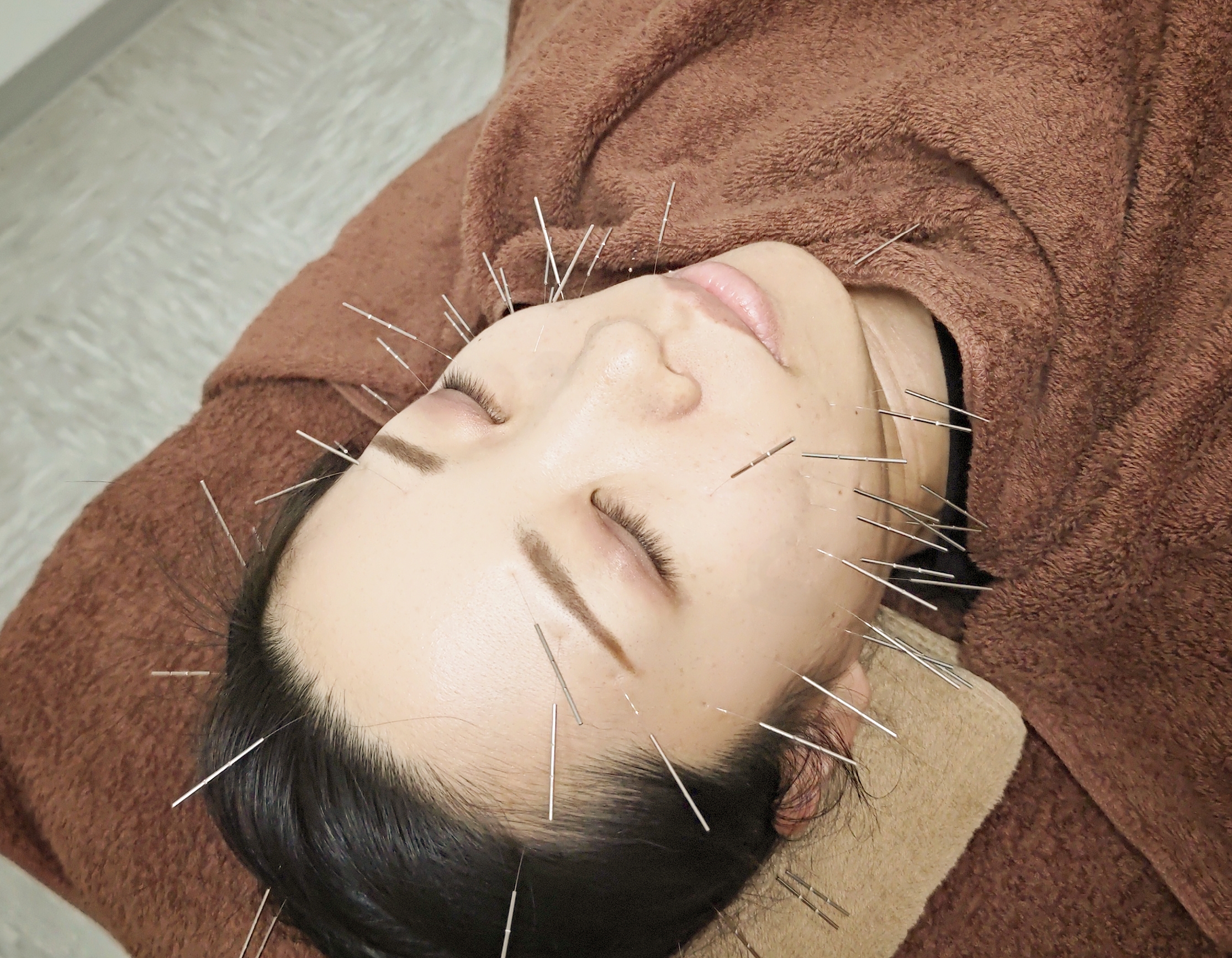 鍼灸整体院プラーナ 【初回割引】美容鍼灸トライアルコース(お顔の鍼)のメニュー画像