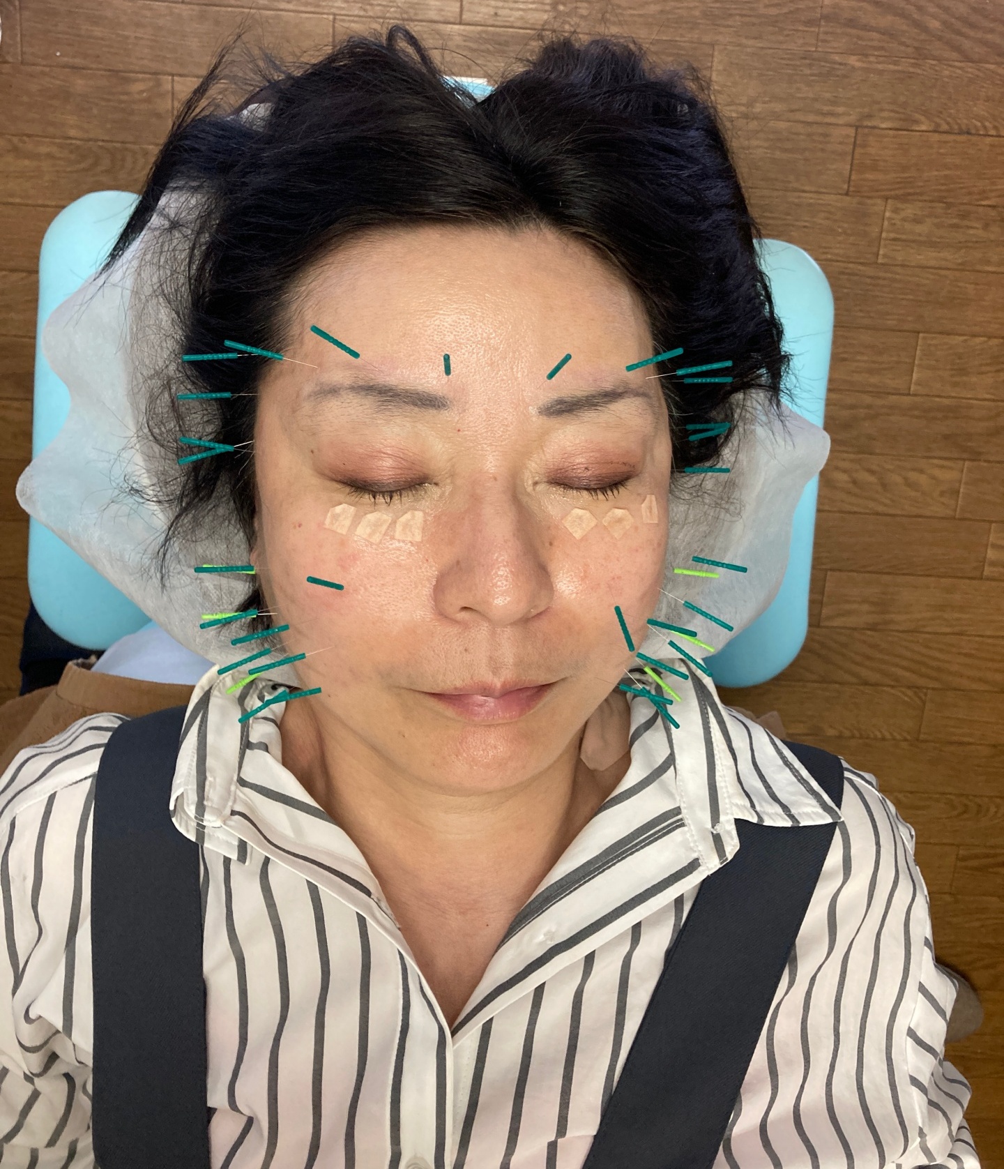 鍼灸　英 美容鍼のメニュー画像