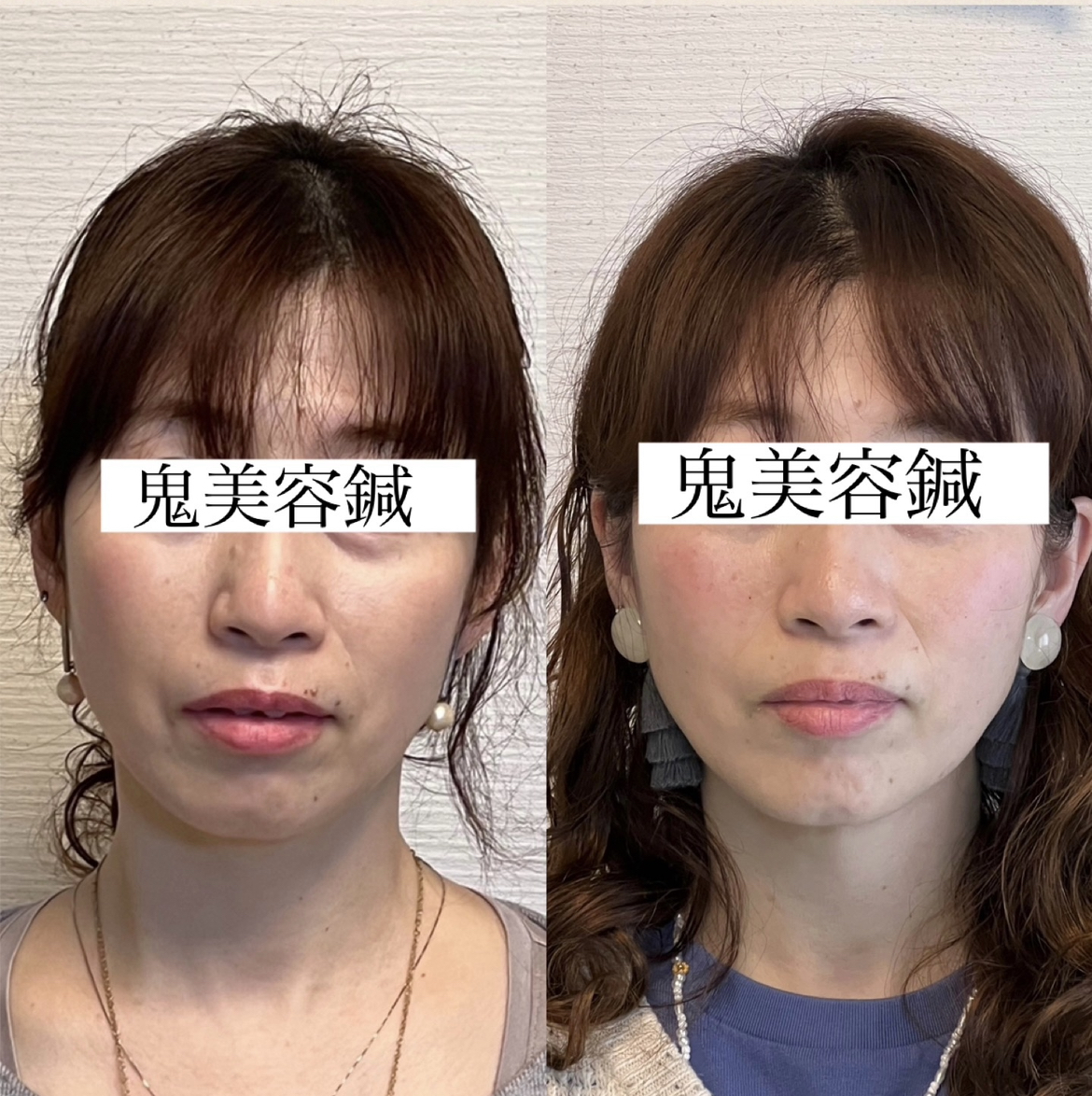 ルート治療・空ルート専門院　鍼処かなしゃ 鬼美容鍼30分コースのメニュー画像