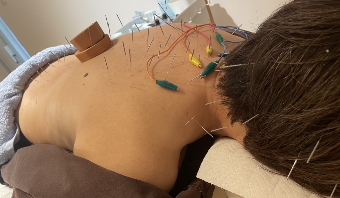 ルーチェ鍼灸整骨院 【身体の鍼灸施術】スタンダードのメニュー画像
