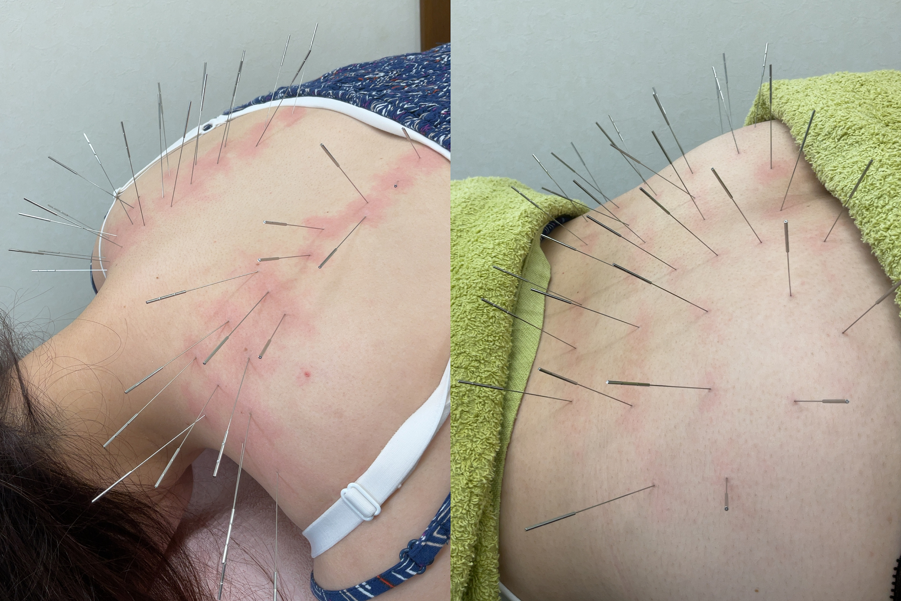 みやけ鍼灸院（ルート治療） ルート治療30分　ショートのメニュー画像
