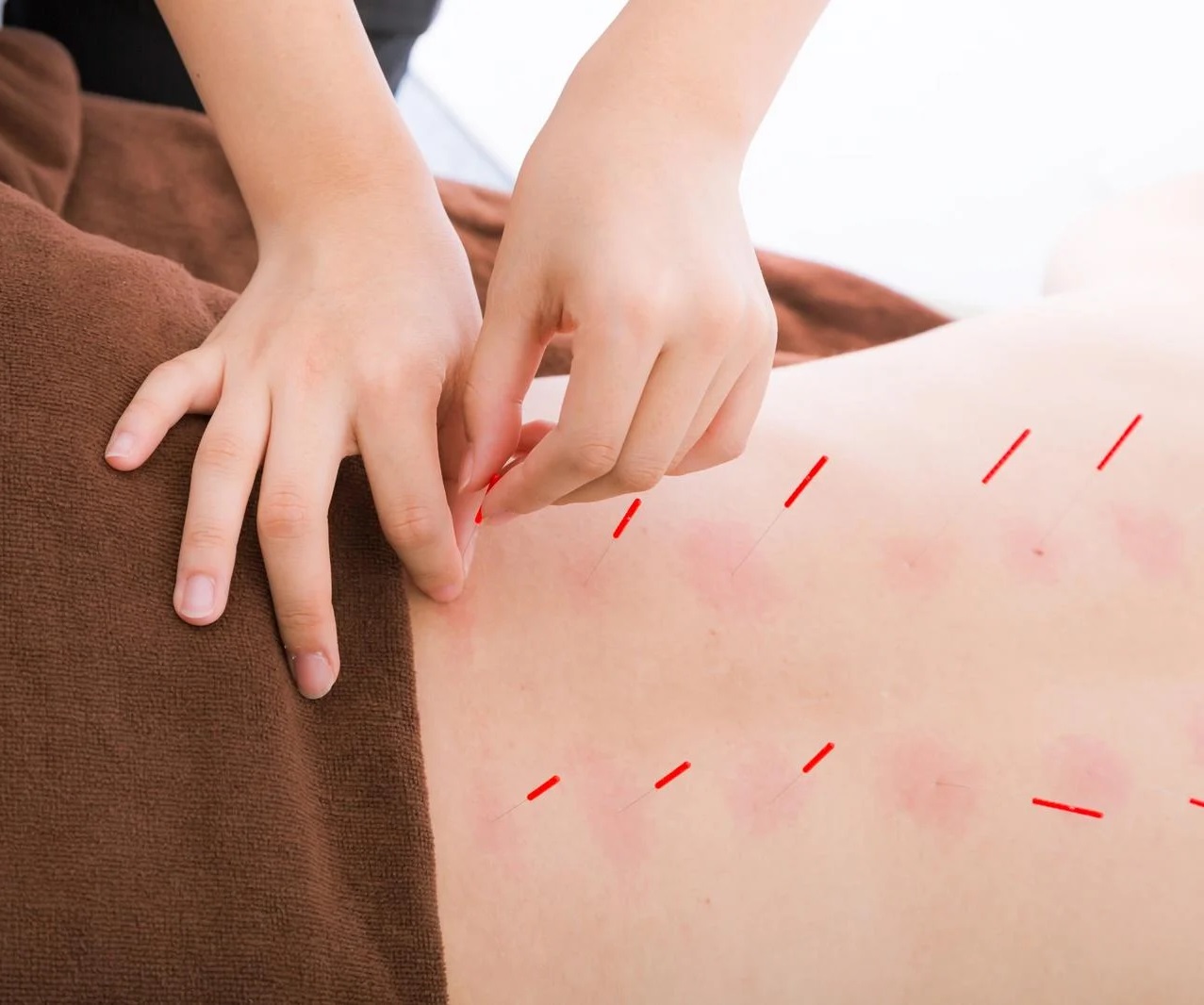 なかむら鍼灸整骨院 改善しない肩コリor腰痛はお任せください！ ハリネズミセラピーのメニュー画像