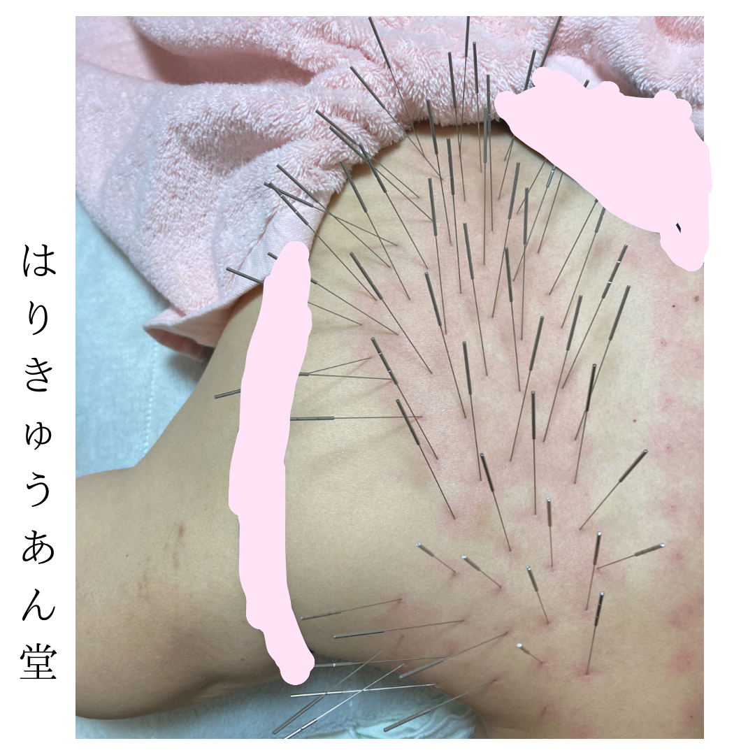 はりきゅうあん堂【ルート治療｜女性専用】 初回の方は必ず追加してください。※問診、事前説明１５分のメニュー画像