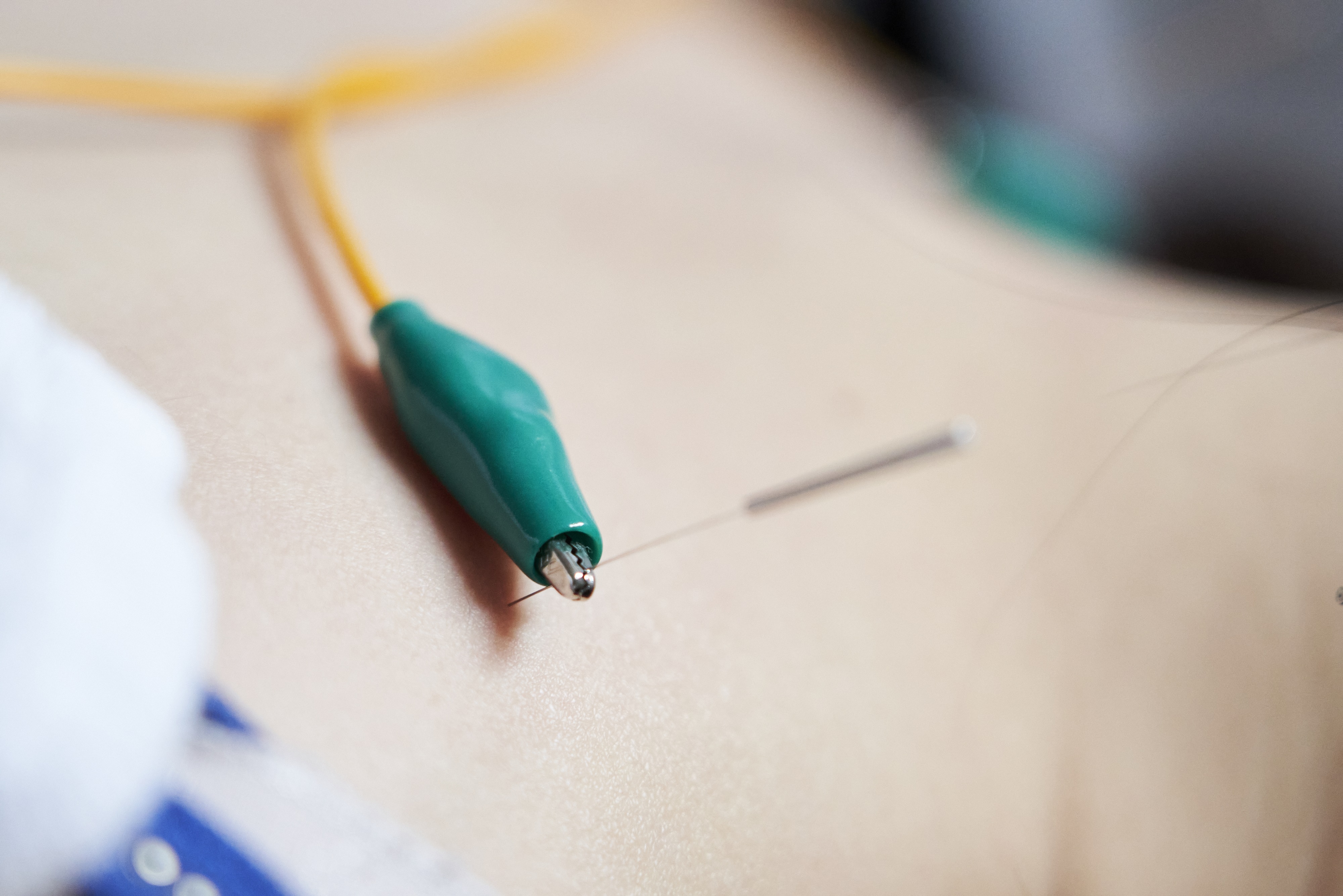 おおい鍼灸院 鍼灸のメニュー画像