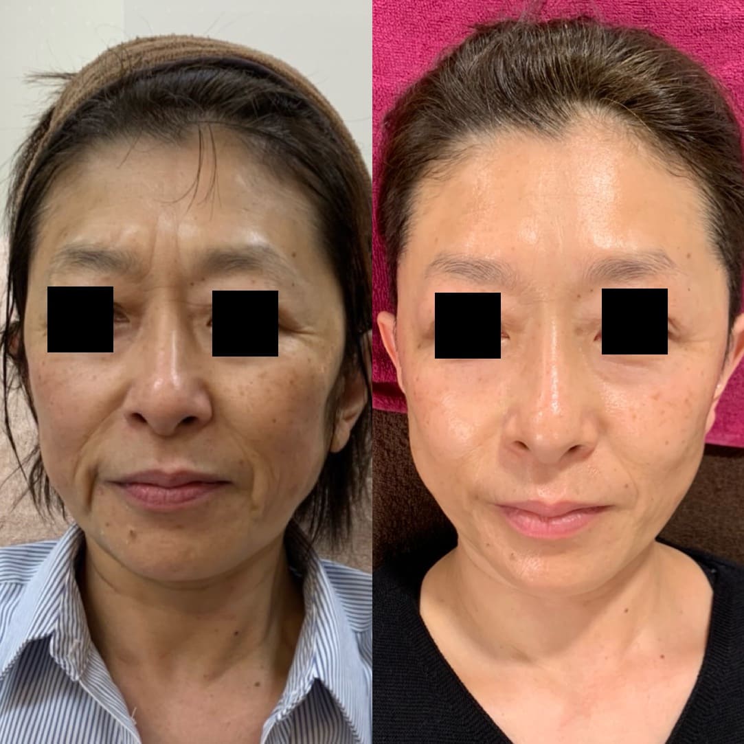 樹はりきゅう・整体院 【限定5名様→1名】たった90日で変える:たるみ肌改善プログラム初回体験のメニュー画像