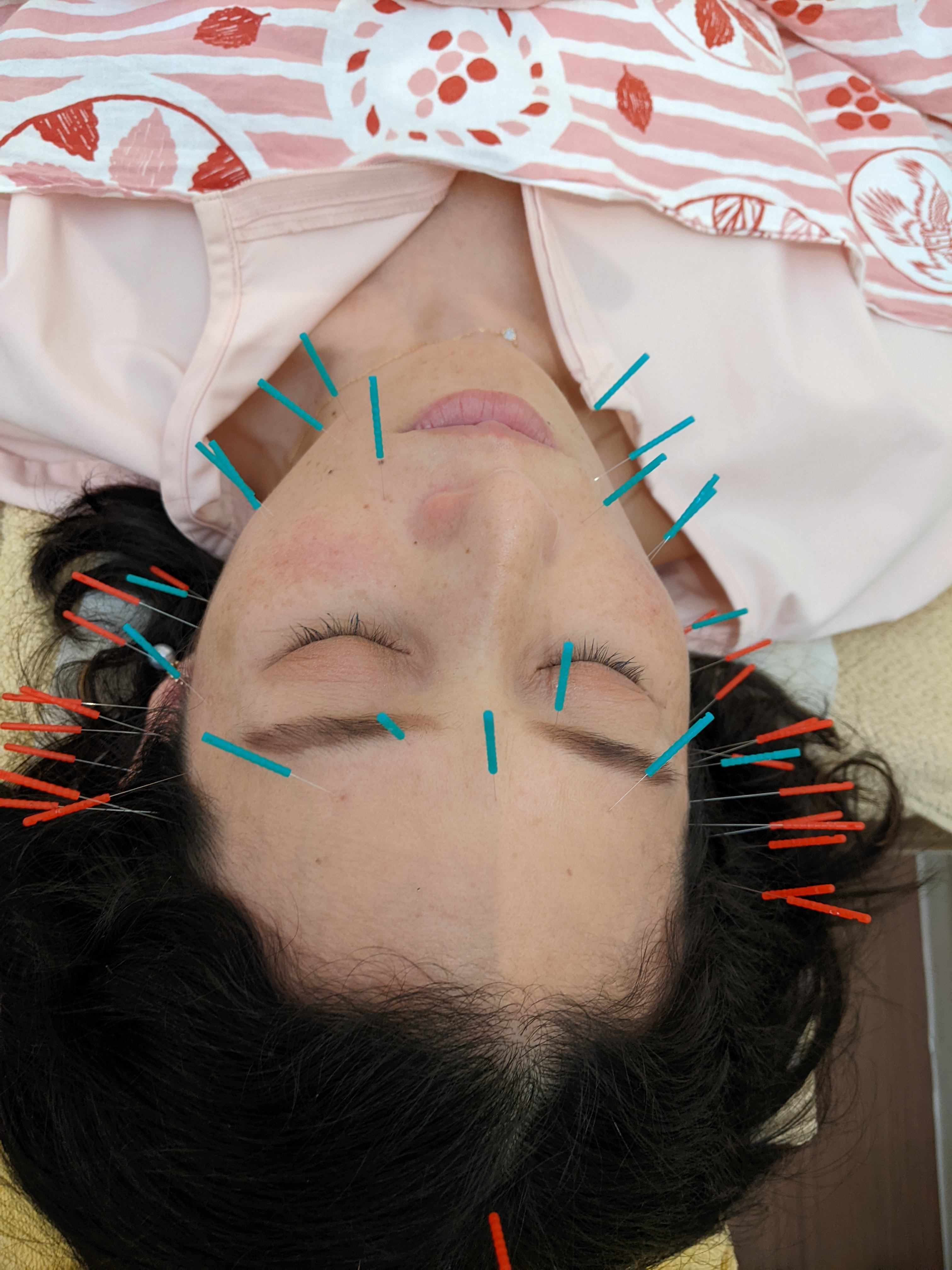 美容鍼灸 Harico 美容鍼10本追加 10needles extraのメニュー画像