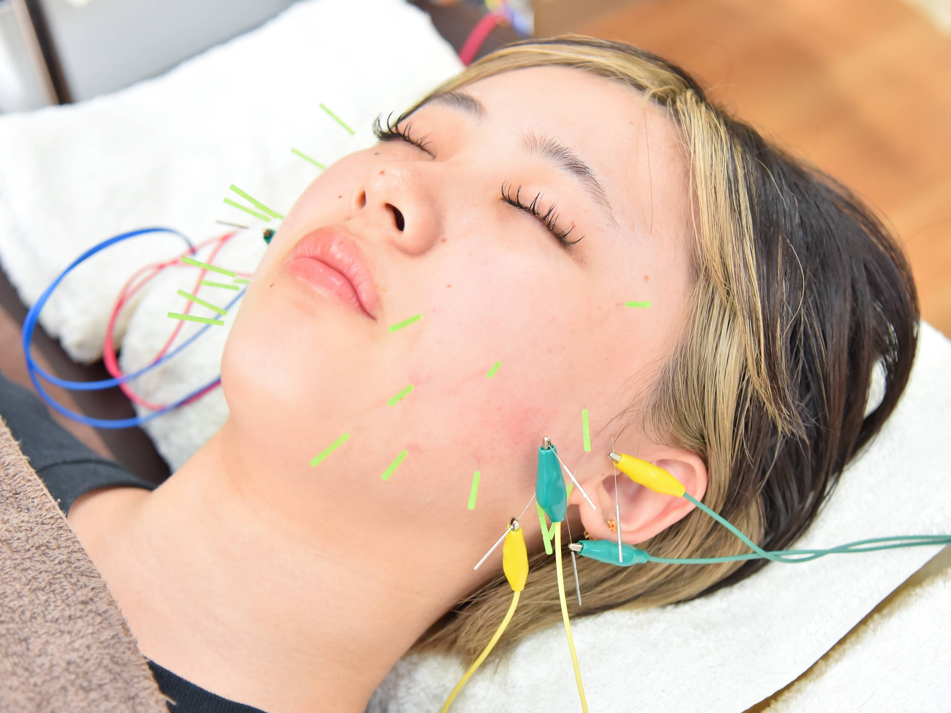 くじら鍼灸・整体院 【初回体験】小顔・リフトアップ美容鍼【エラ張り/食いしばりにおすすめ】のメニュー画像