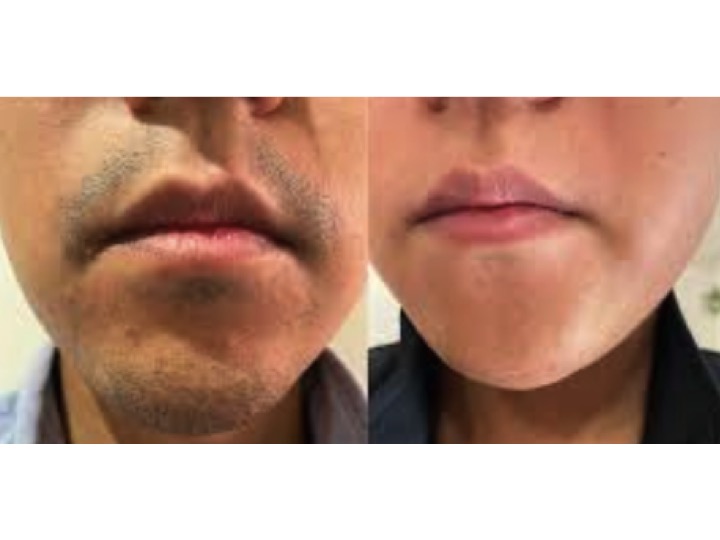 たいよう鍼灸整骨院conditioning labo(ルート治療認定院) ヒゲ脱毛のメニュー画像