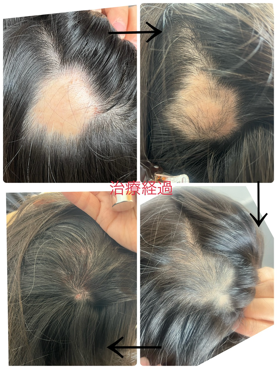 鍼灸salon　 ASENS   ルート治療院 【高砂院】ルート育毛治療40分のメニュー画像