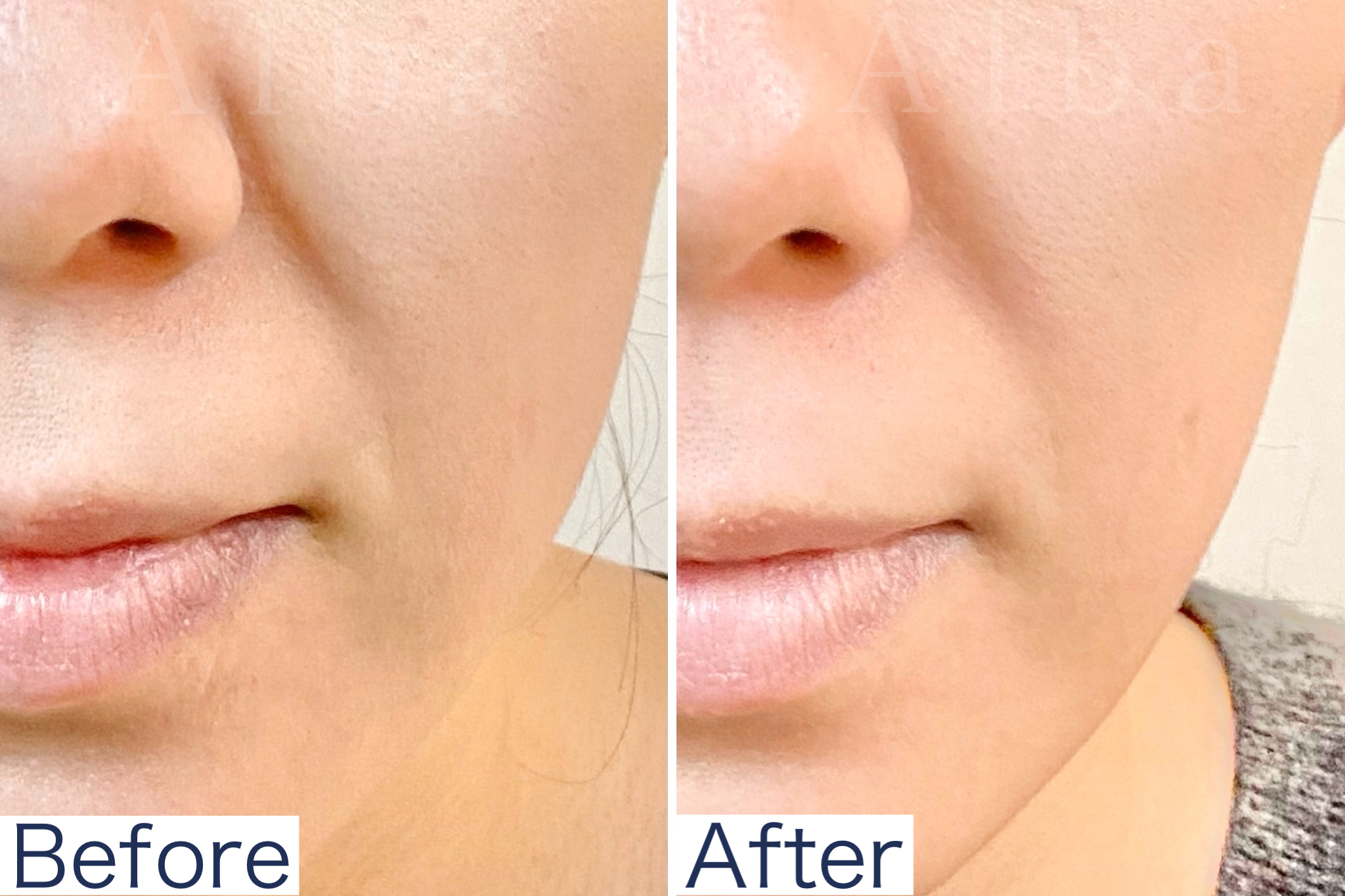 たるみ専門 美容鍼灸 アルバ たるみケア60分のメニュー画像