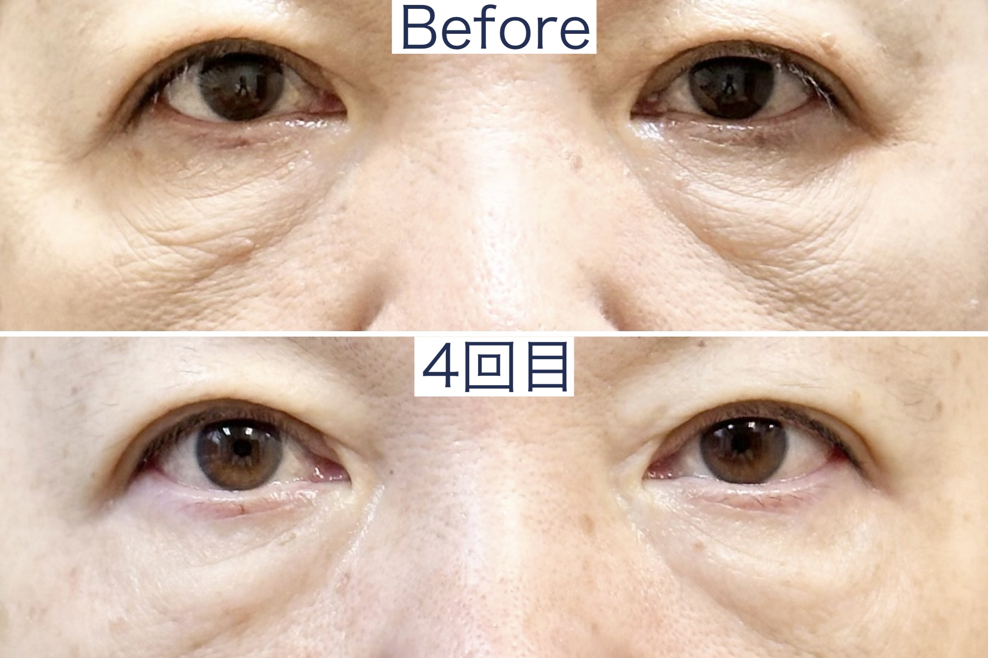 たるみ専門 美容鍼灸 アルバ たるみケア集中コースのメニュー画像