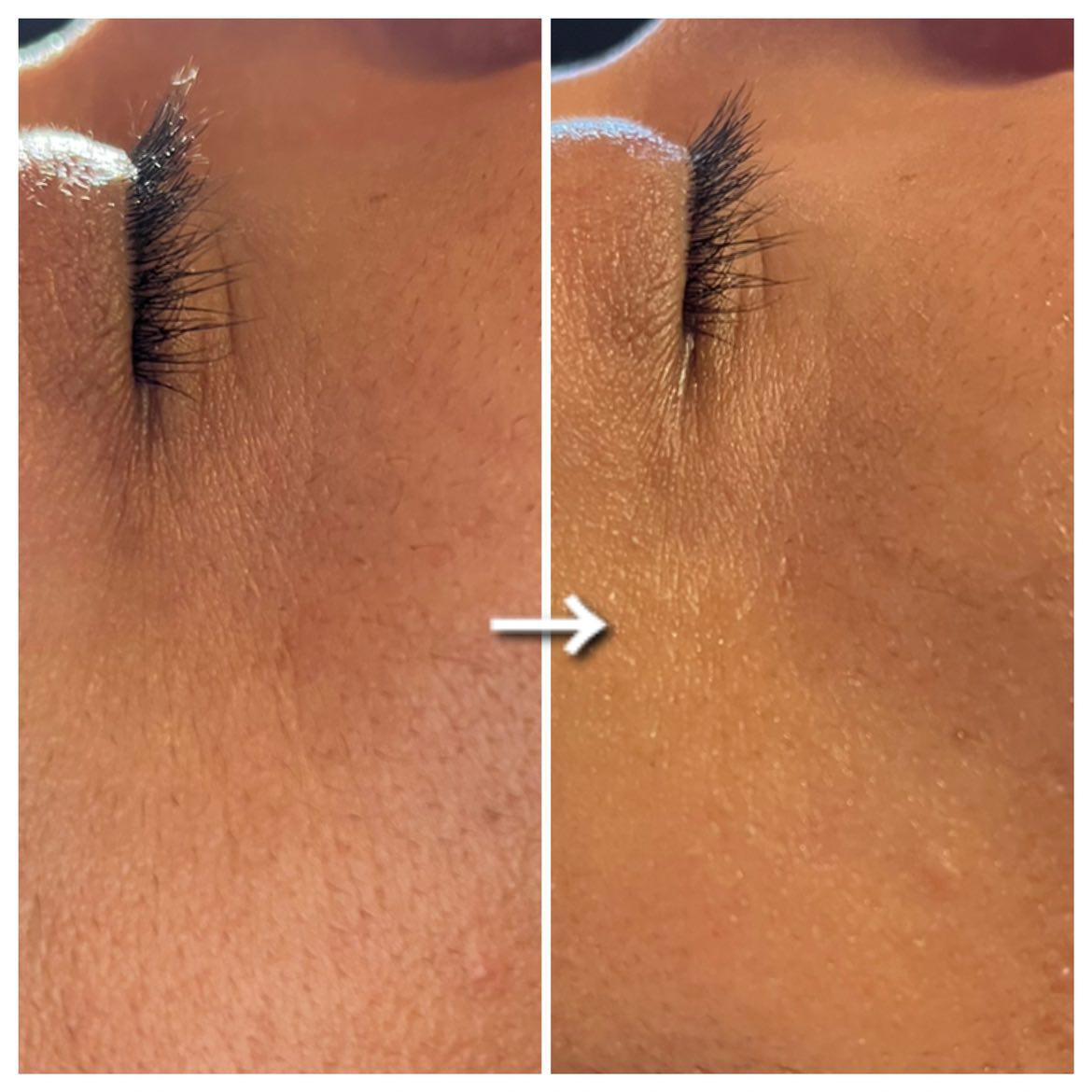 LUX美容鍼灸整体 美魔女鍼コース　毎月５名限定(１月分）　初回限定価格通常￥19800→8980のメニュー画像