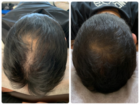 ルート治療専門　ながえ鍼灸院 ルート薄毛治療のメニュー画像