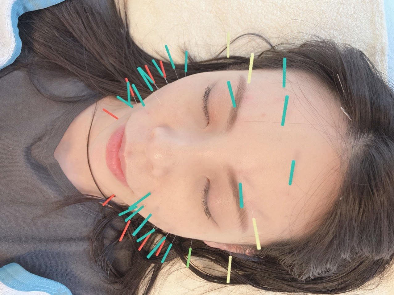 【女性専用】美容鍼灸サロンよもぎ 【食いしばりによるエラ張り＆小顔＆リフトアップ】健康美容鍼灸・鍼多めコースのメニュー画像