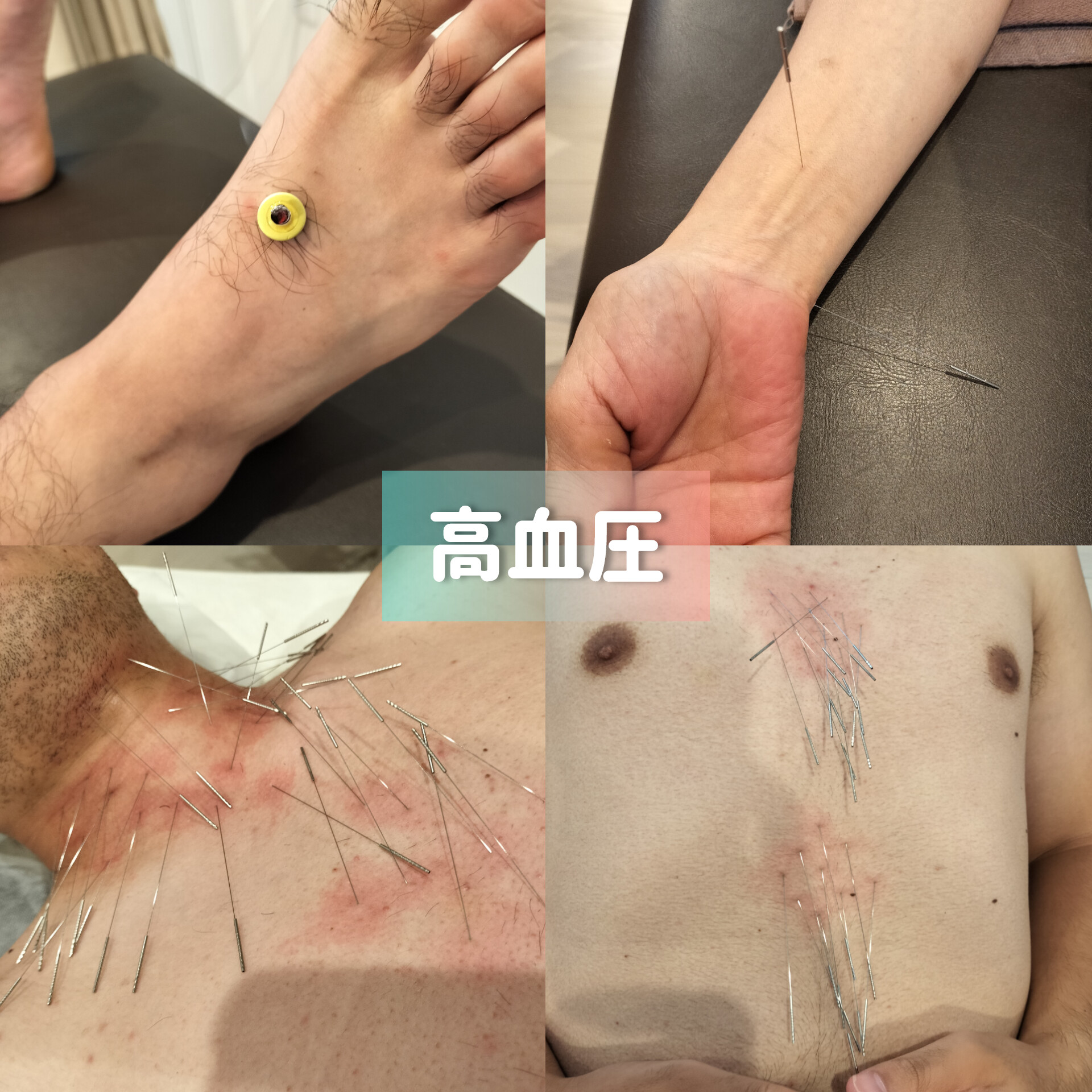 ハリ屋アンティーク 高血圧短期集中改善プランのお試しのメニュー画像
