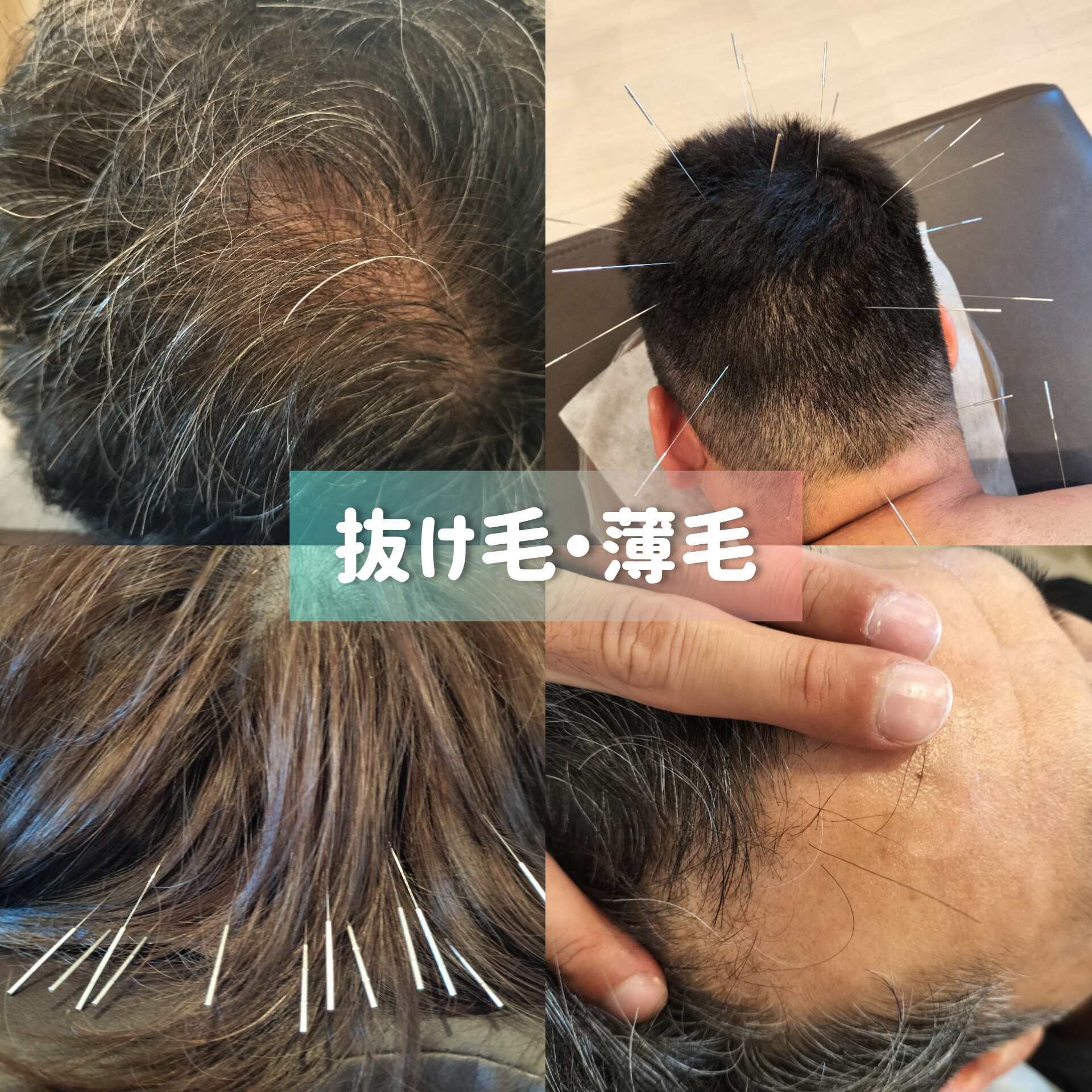 ハリ屋アンティーク 抜け毛・薄毛短期集中改善プランのお試しのメニュー画像