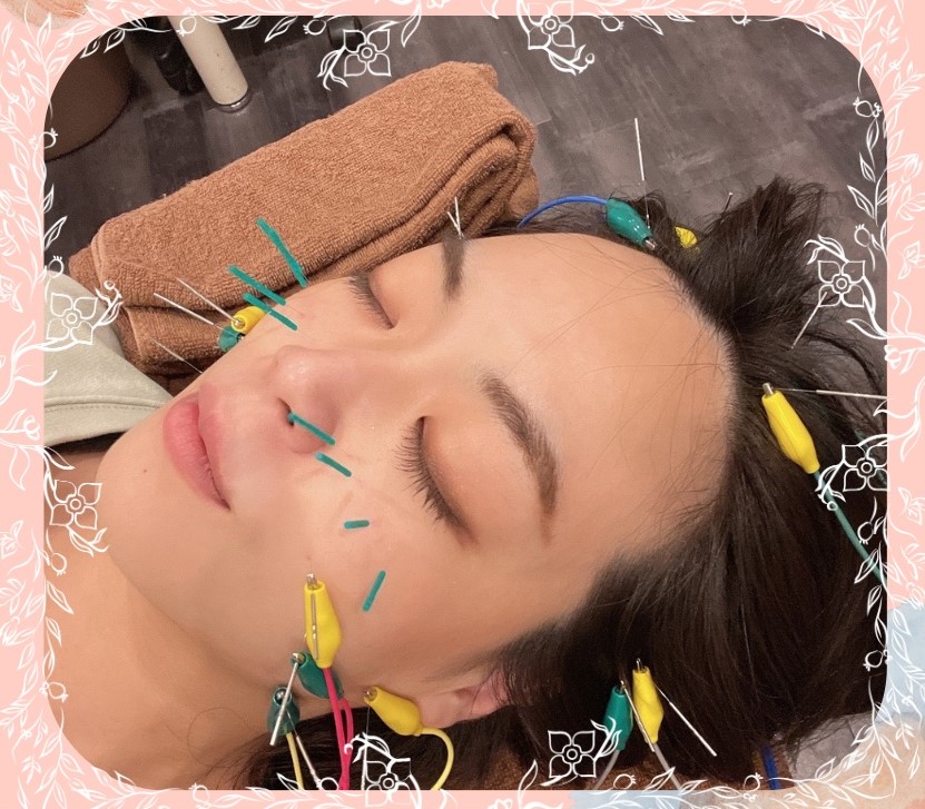 こころ鍼灸院　中井院 美容鍼　OPEN体験！のメニュー画像