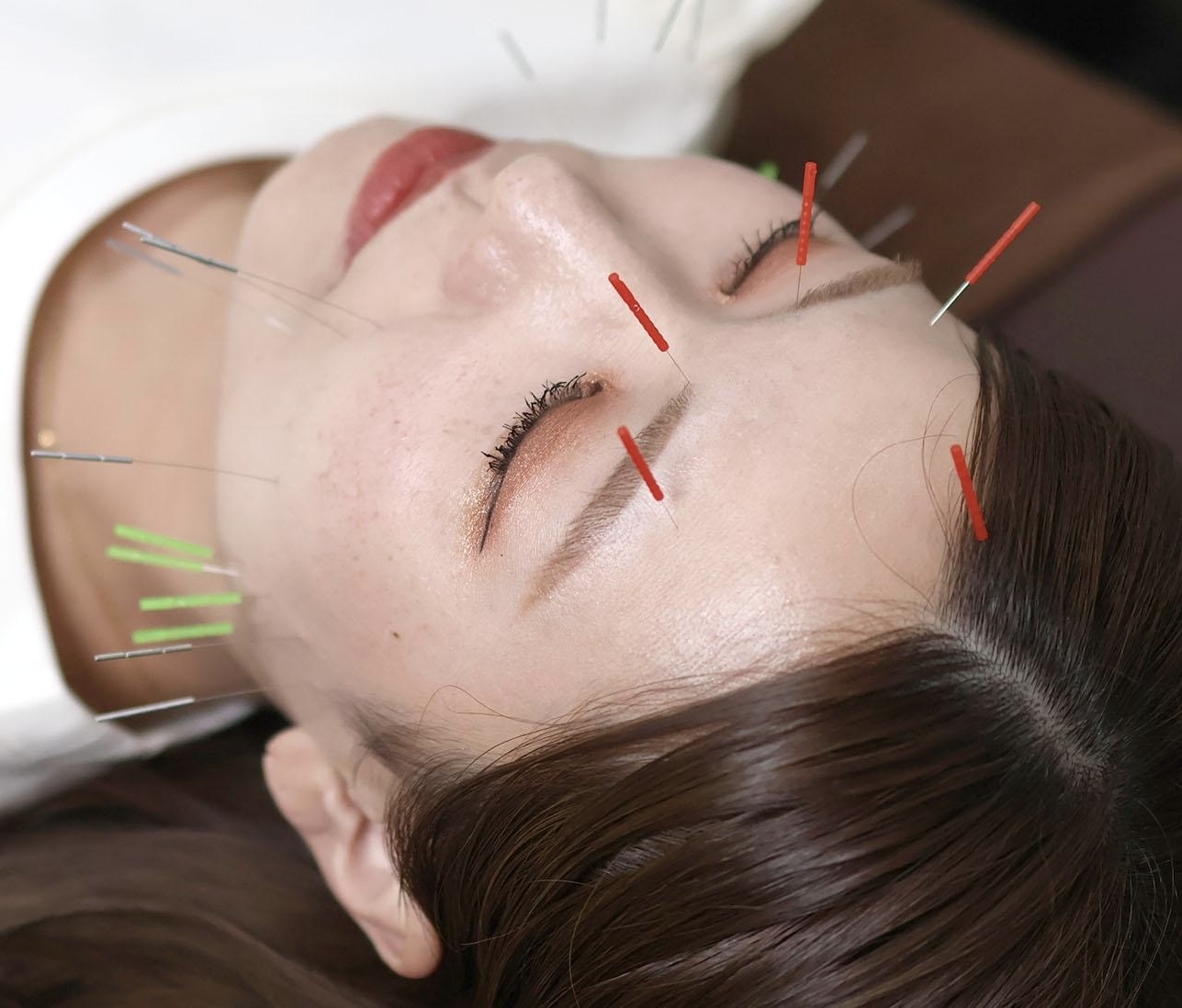 たけだ整体院鍼灸院 1回で小顔実感！スッキリ◎【小顔矯正＋美容鍼＋ヘッド】 鍼30本のメニュー画像