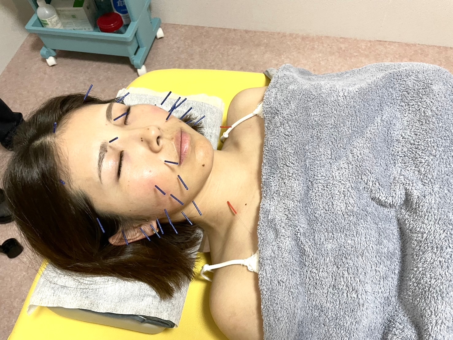 みずぬま鍼灸院 初めて来院の方　美容鍼スタンダードコースのメニュー画像