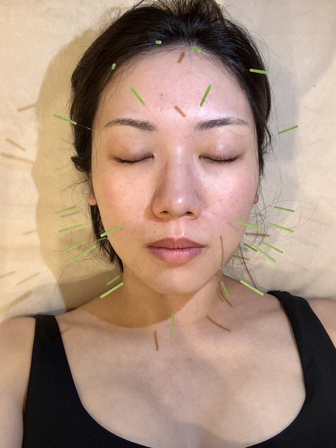 訪問鍼灸院Aruku 美容鍼のメニュー画像