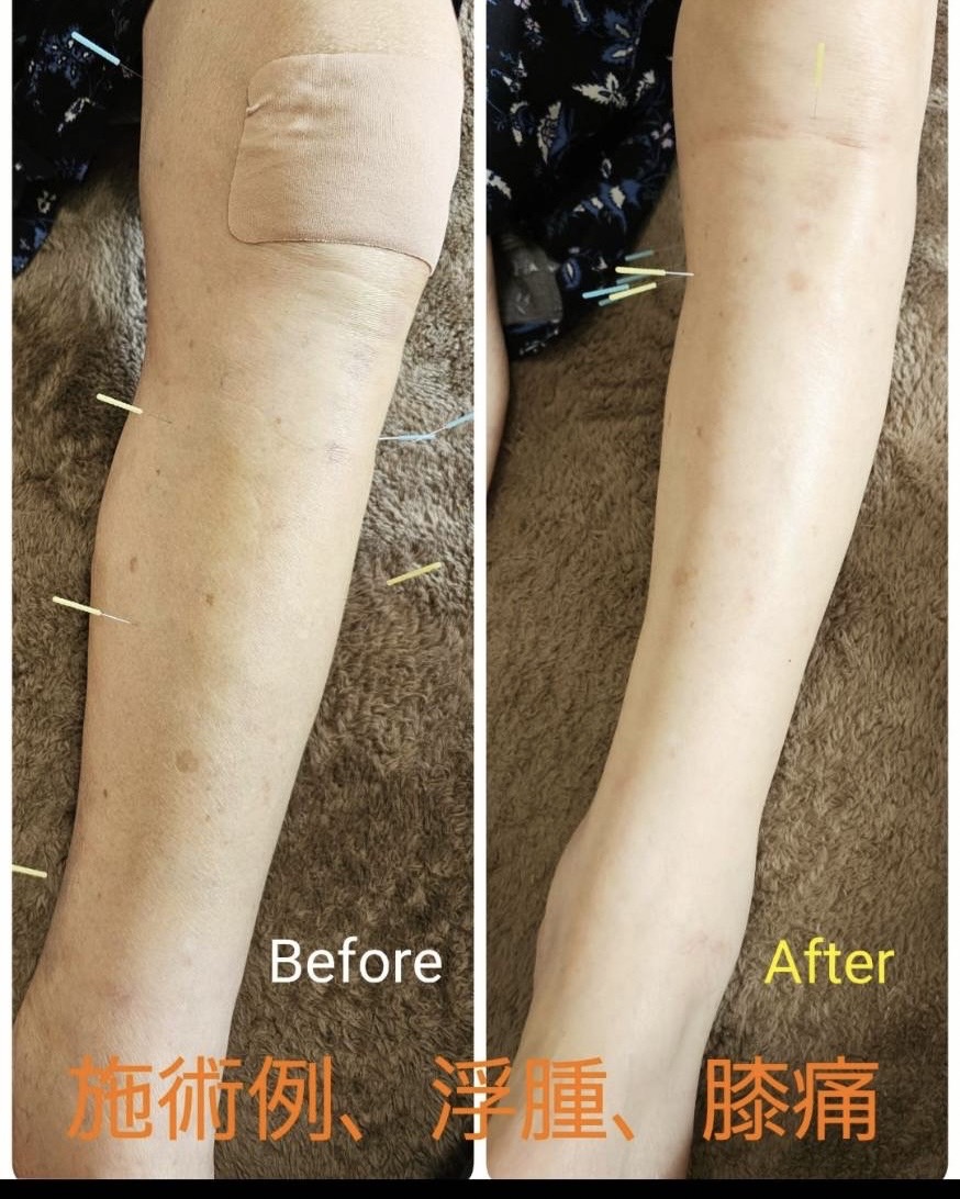 訪問鍼灸院Aruku 【鍼灸施術×ストレッチ】のメニュー画像