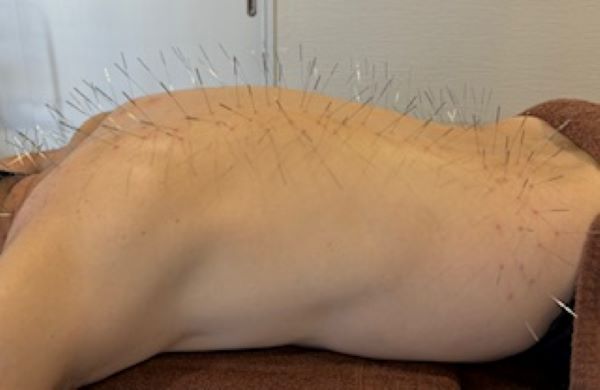 鍼日和 ルート治療60分 当院のスタンダードメニューになります!のメニュー画像