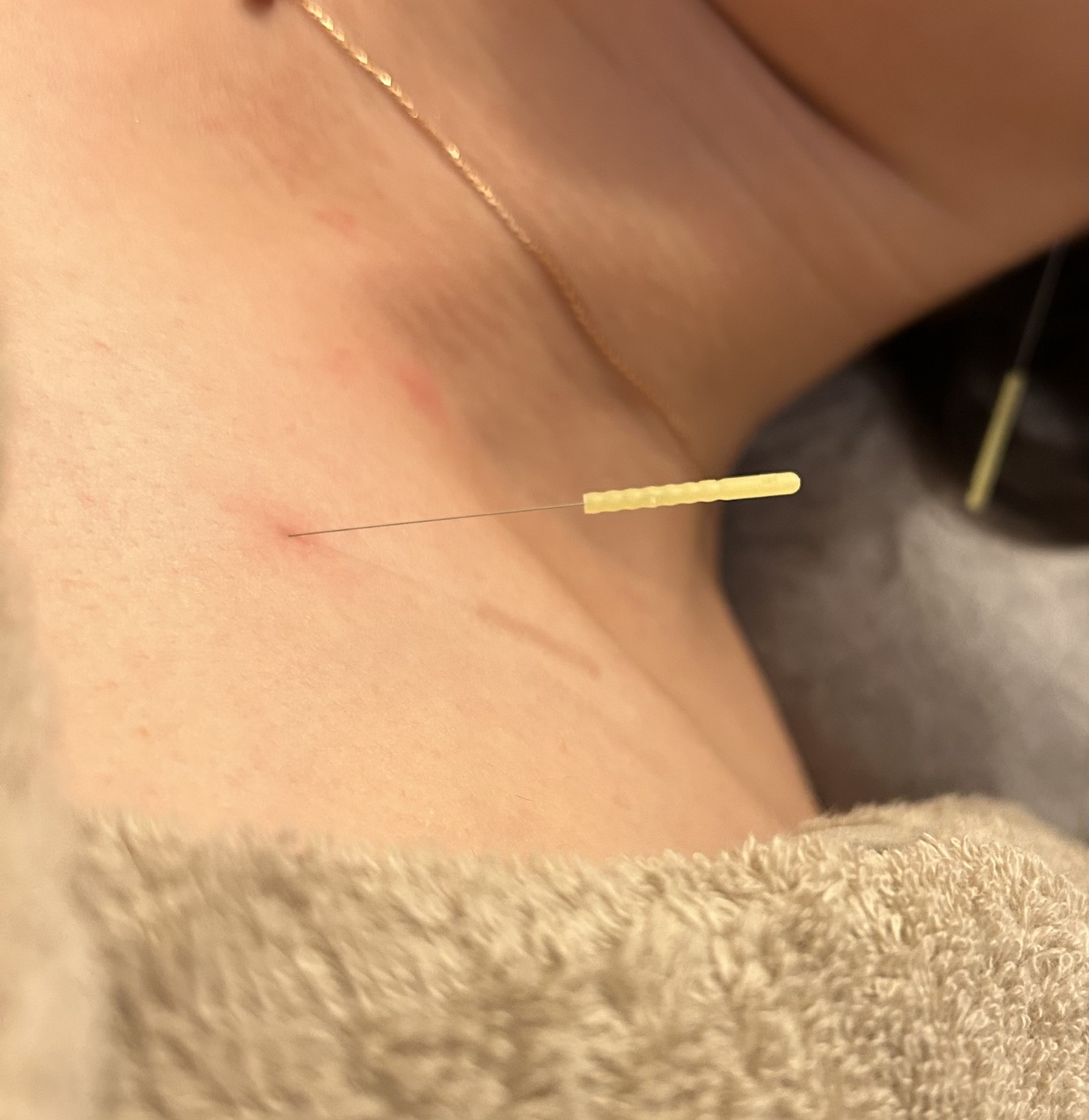 鍼灸院まめ NO.2【オーダーメイド＋身体を整えて健康に美しく】全身鍼灸＋美容鍼灸のメニュー画像