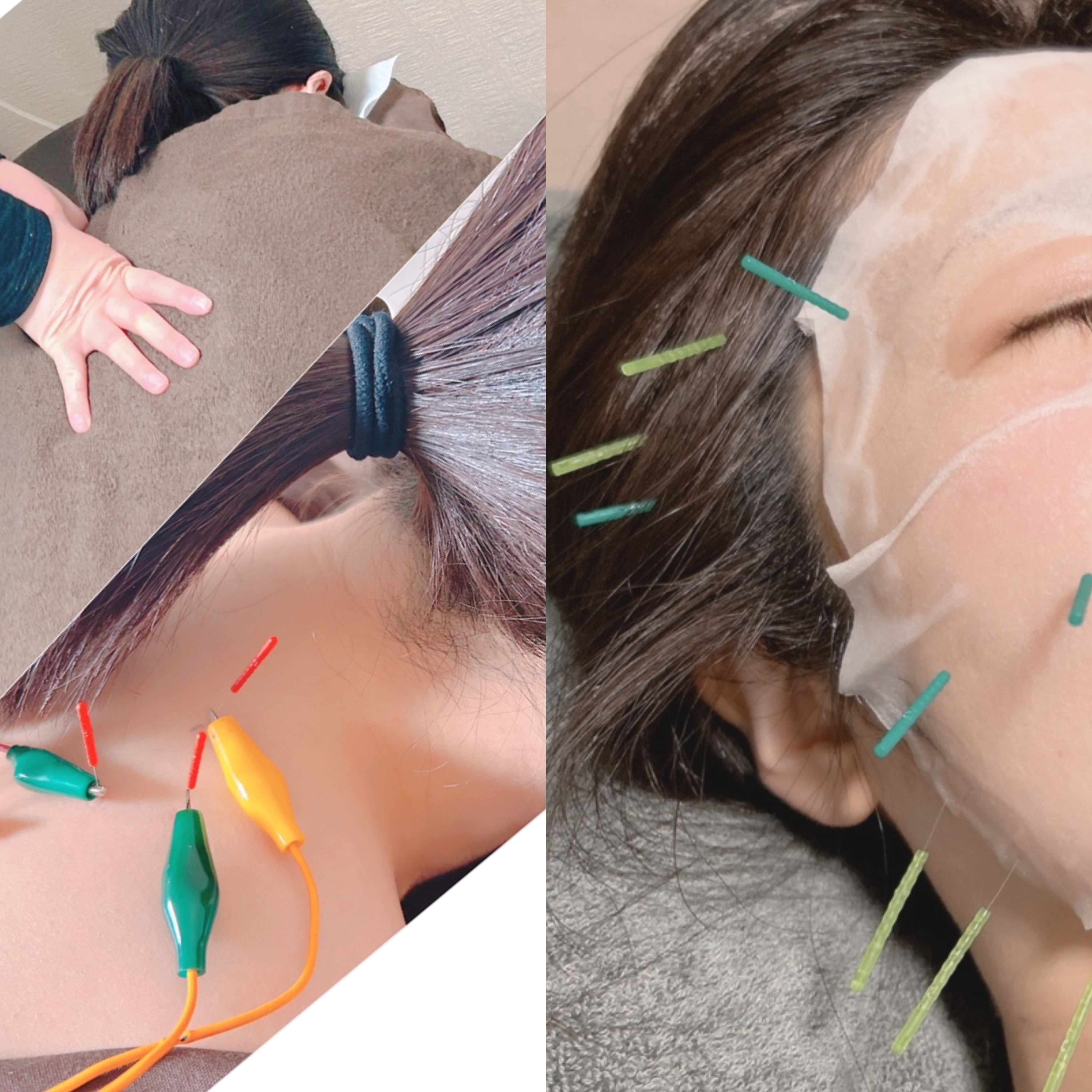 いずみ鍼灸マッサージ院 【1番人気！お得】ボディ鍼灸指圧＋《美容鍼》高保湿パック付き★のメニュー画像