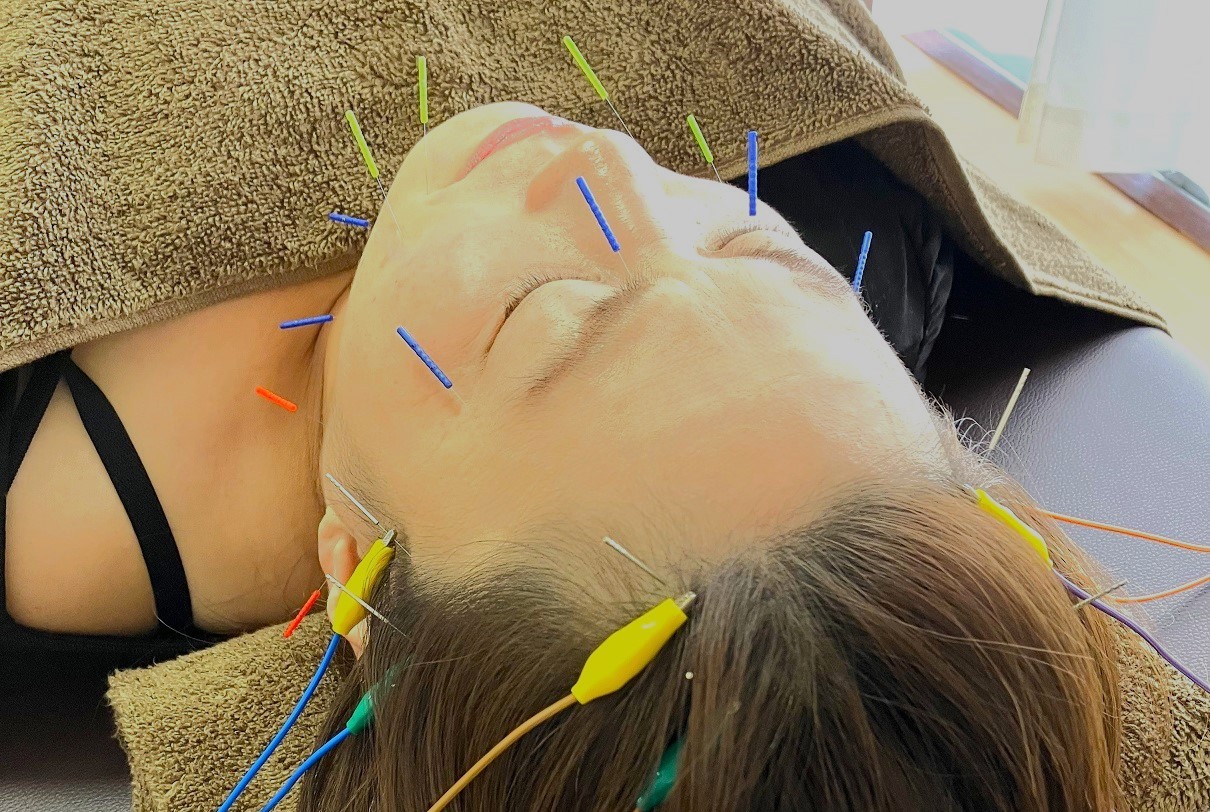 出張鍼灸整体hiro リフトアップ⤴美容鍼（お試し）のメニュー画像