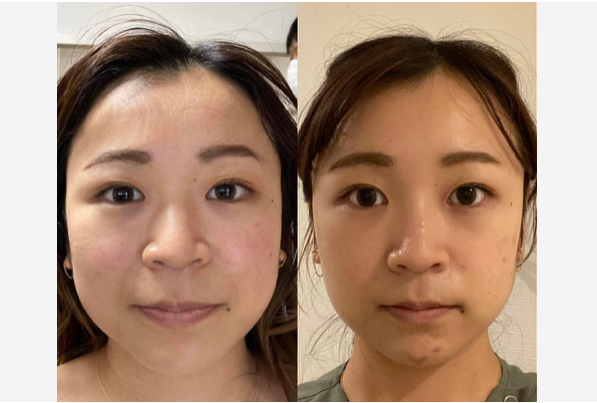 ハピネス鍼灸院 圧倒的な効果⭐️ルート鬼美容鍼のメニュー画像