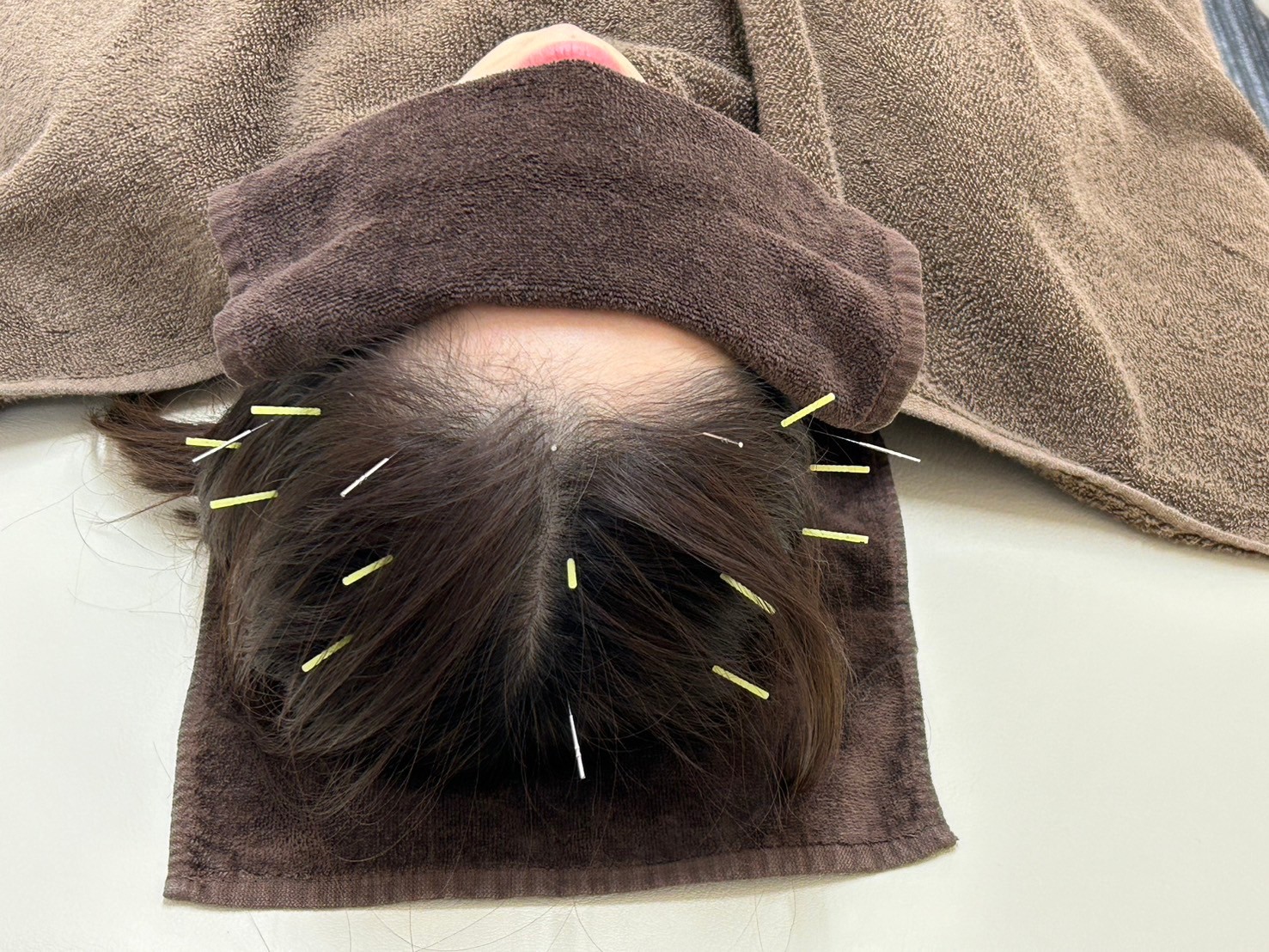 スカイブルー鍼灸接骨院 【新規限定】頭痛改善コース(頭痛で長年悩んでいる方におすすめ)のメニュー画像