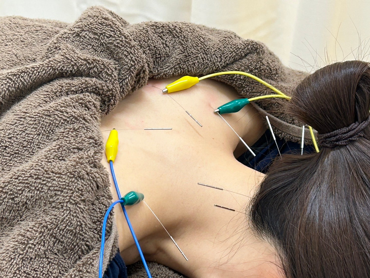 スカイブルー鍼灸接骨院 【新規限定】鍼灸×肩甲骨はがし(姿勢が悪く首肩こりが辛い方におすすめ)のメニュー画像