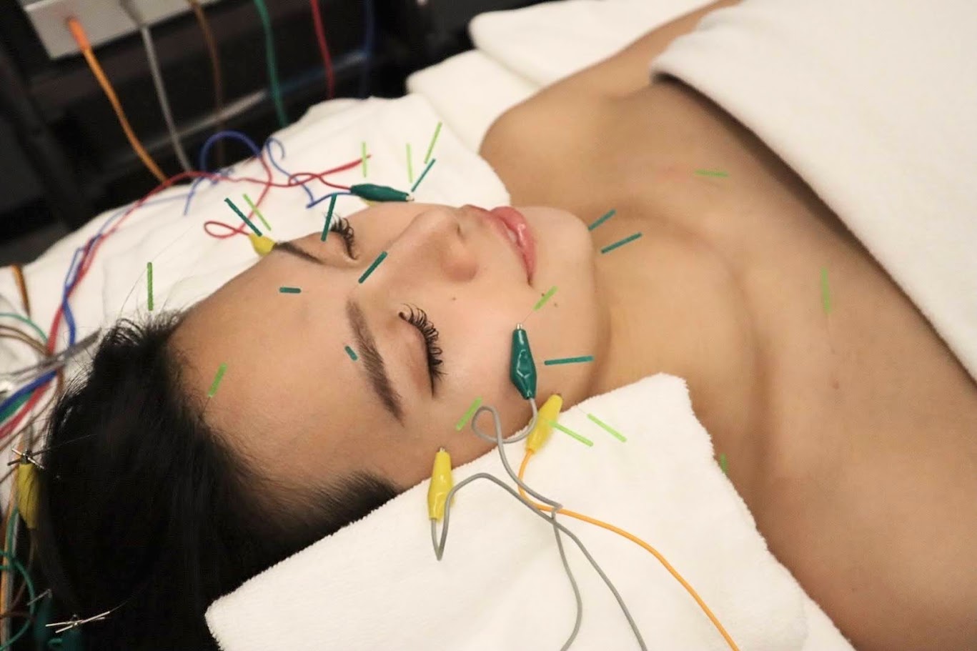DOLCE BEAUTY SALON 美容鍼DOLCEコース【しわ・たるみ改善/リフトアップ・小顔】のメニュー画像